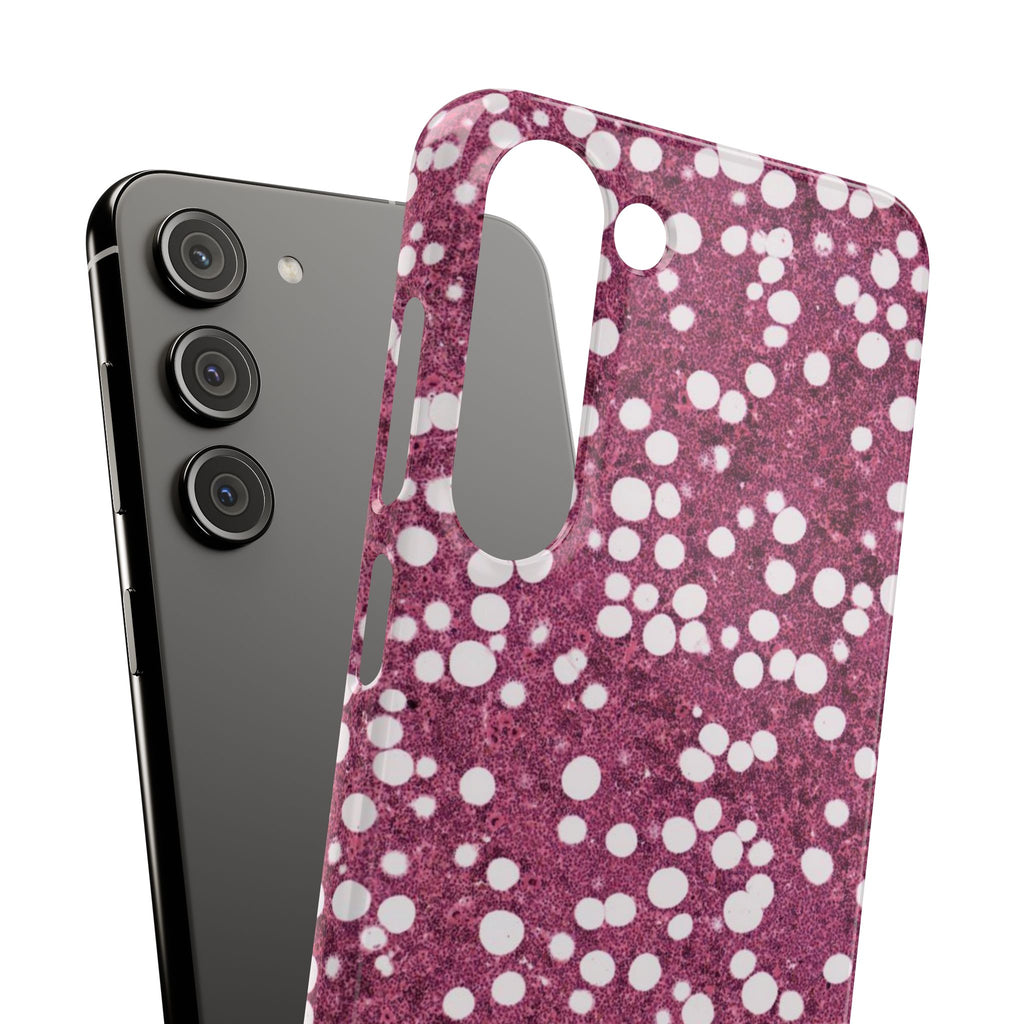 Slim Case Myelolipom