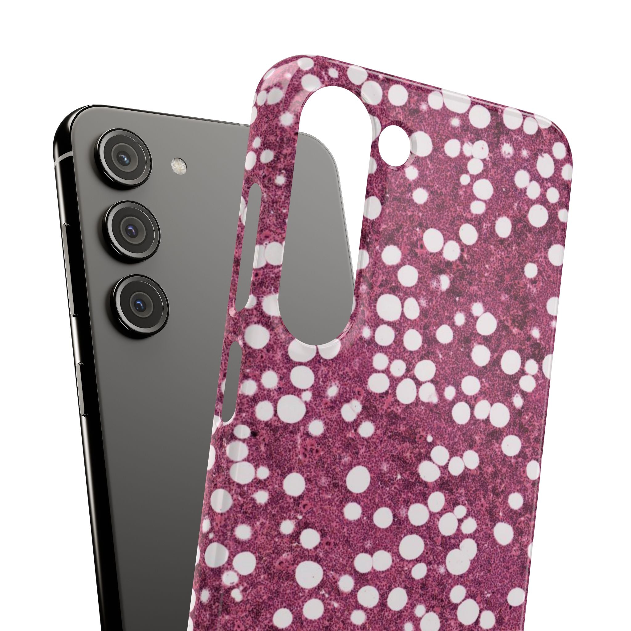 Slim Case Myelolipom