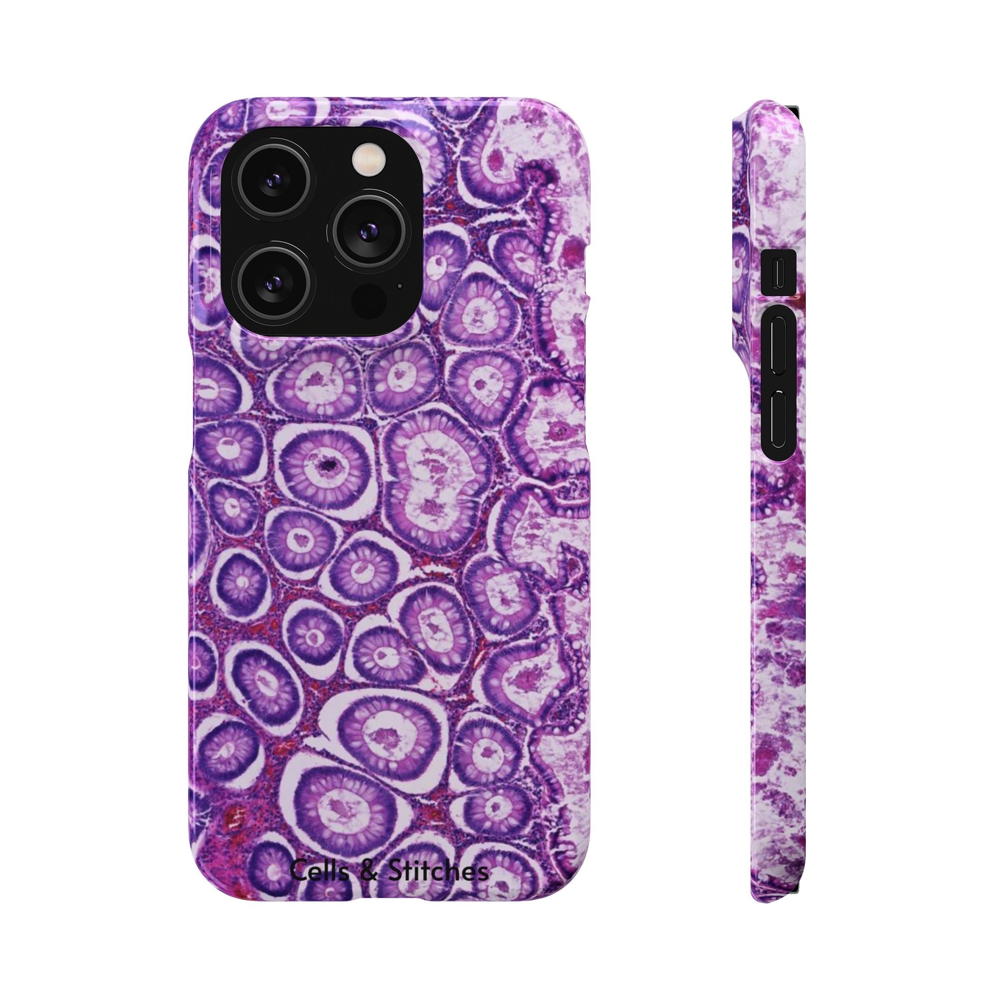 Slim Case Peutz-Jeghers Polyp
