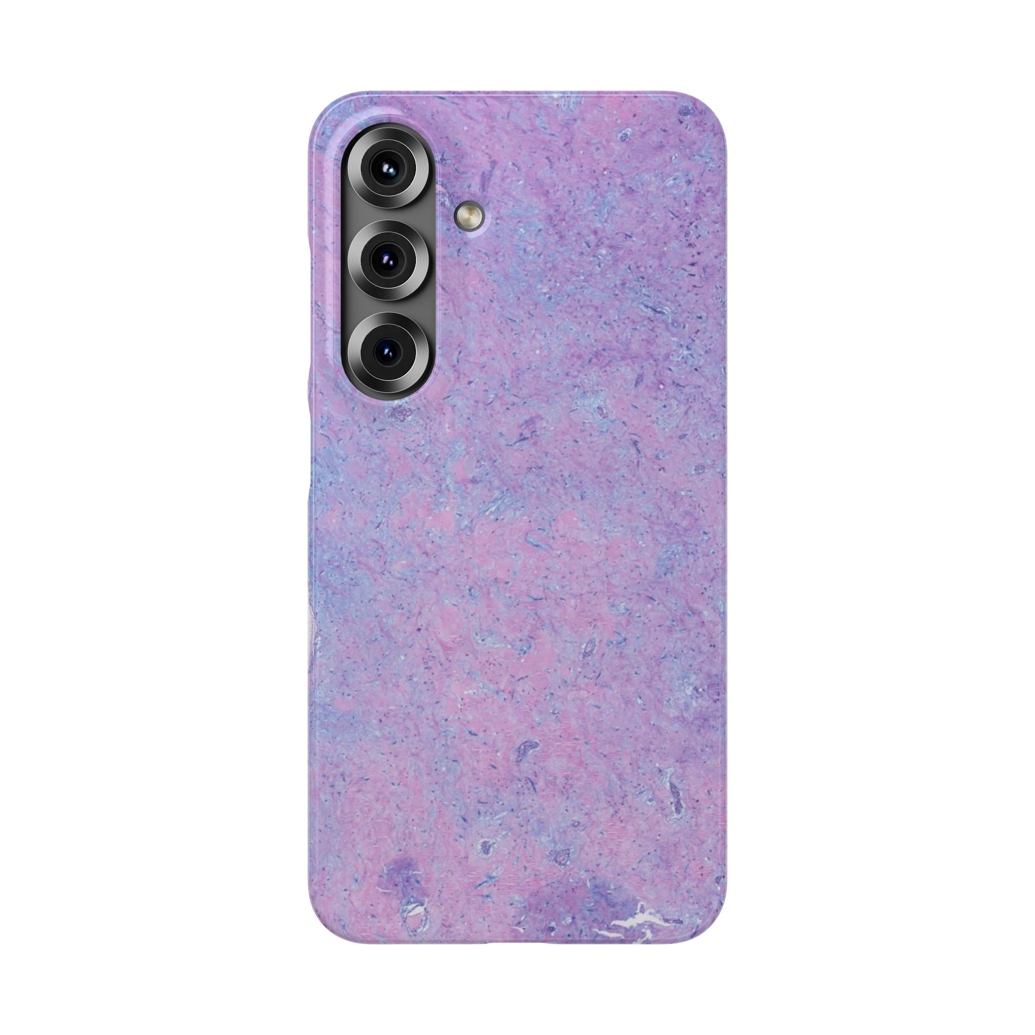 Slim Case Arterielles Myxom
