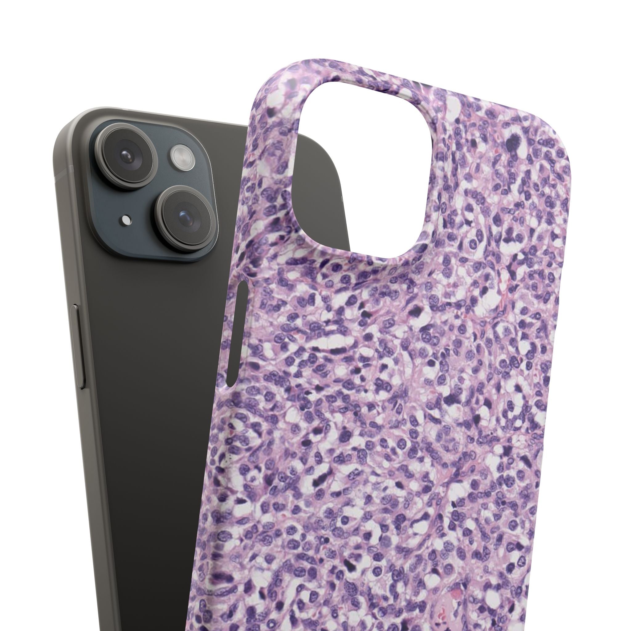 Slim Case Paraganglion
