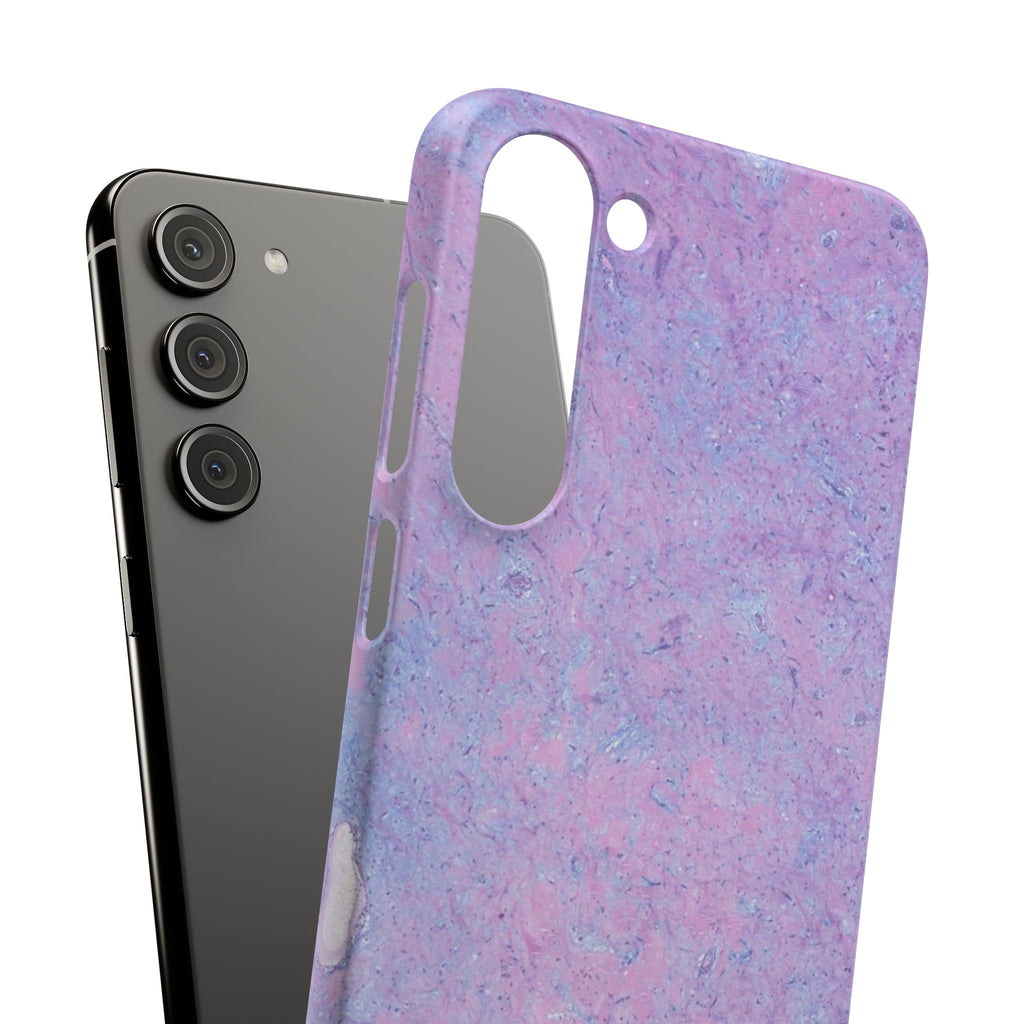 Slim Case Arterielles Myxom
