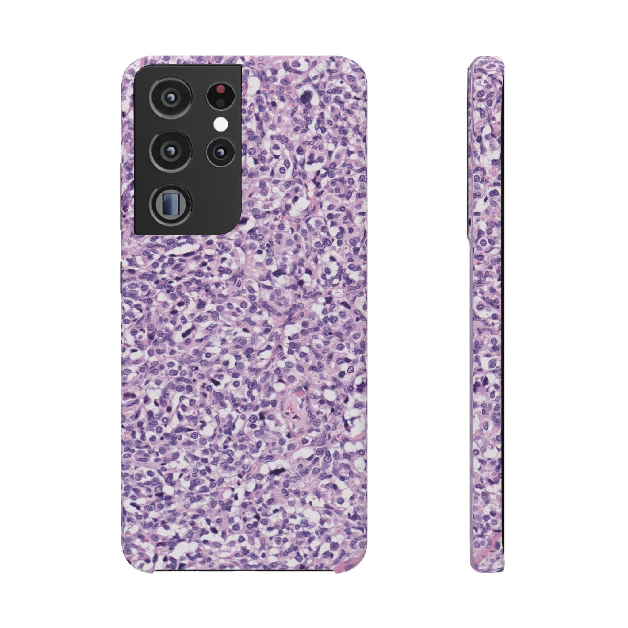 Slim Case Paraganglion