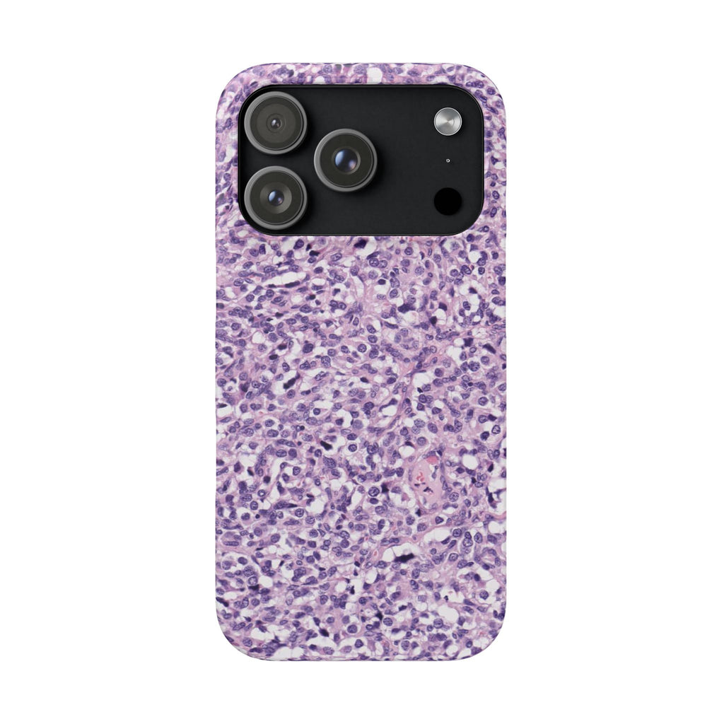 Slim Case Paraganglion