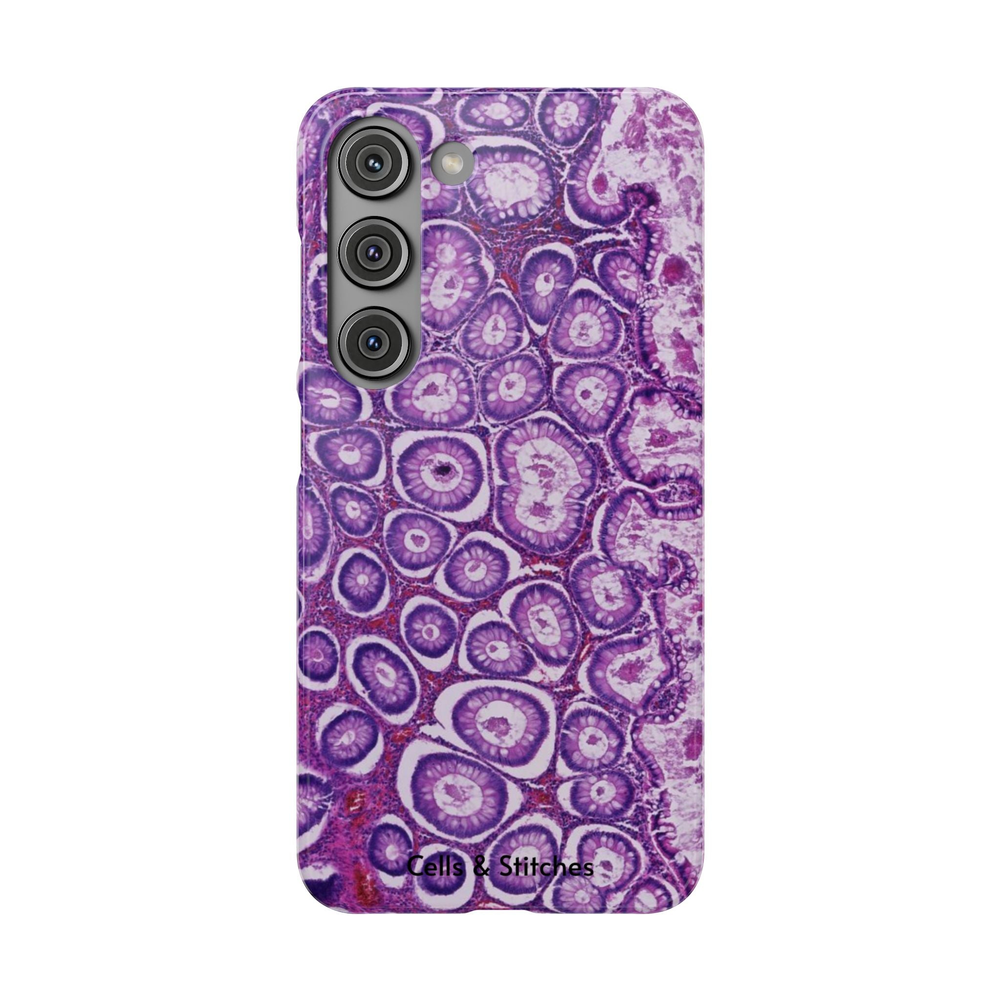 Slim Case Peutz-Jeghers Polyp