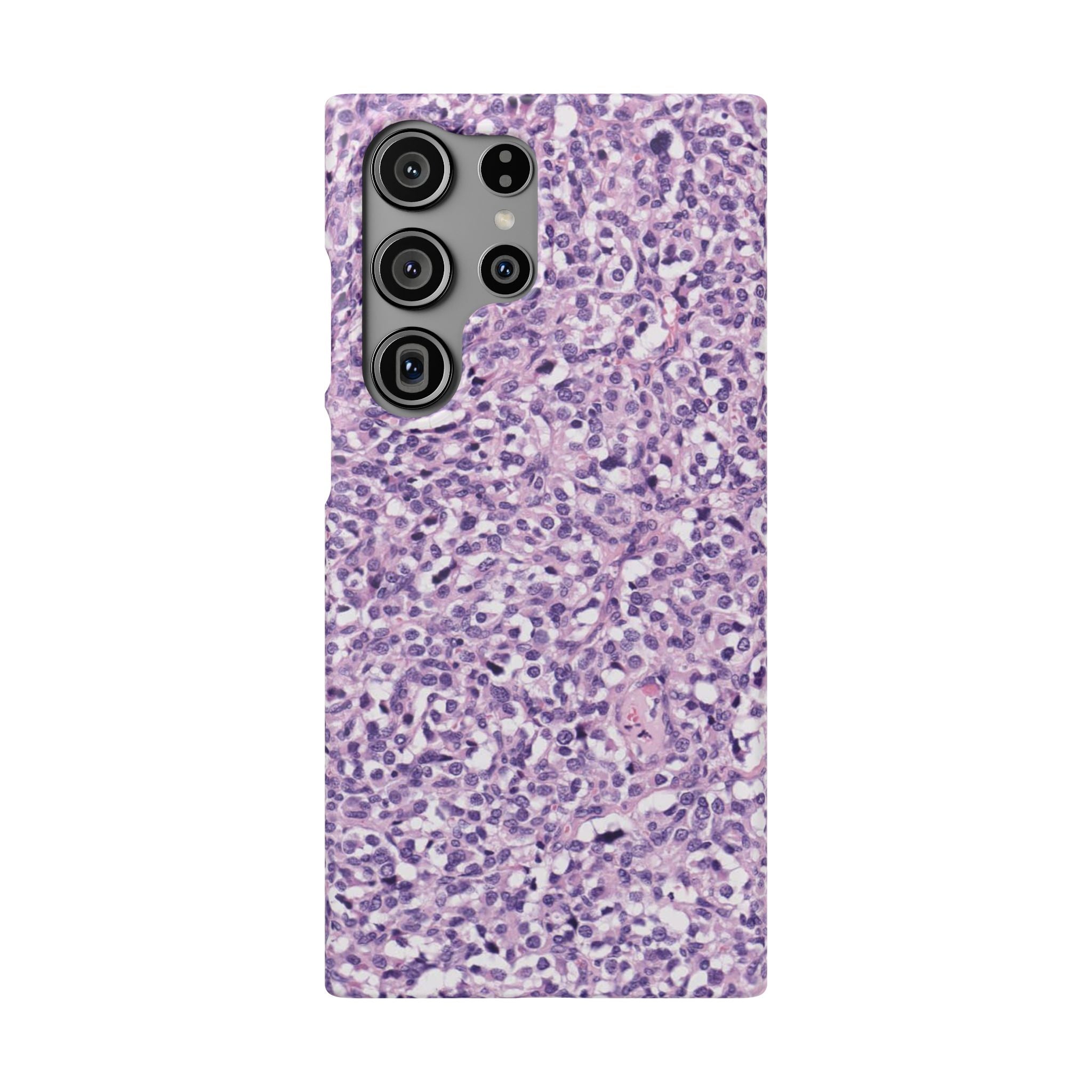 Slim Case Paraganglion