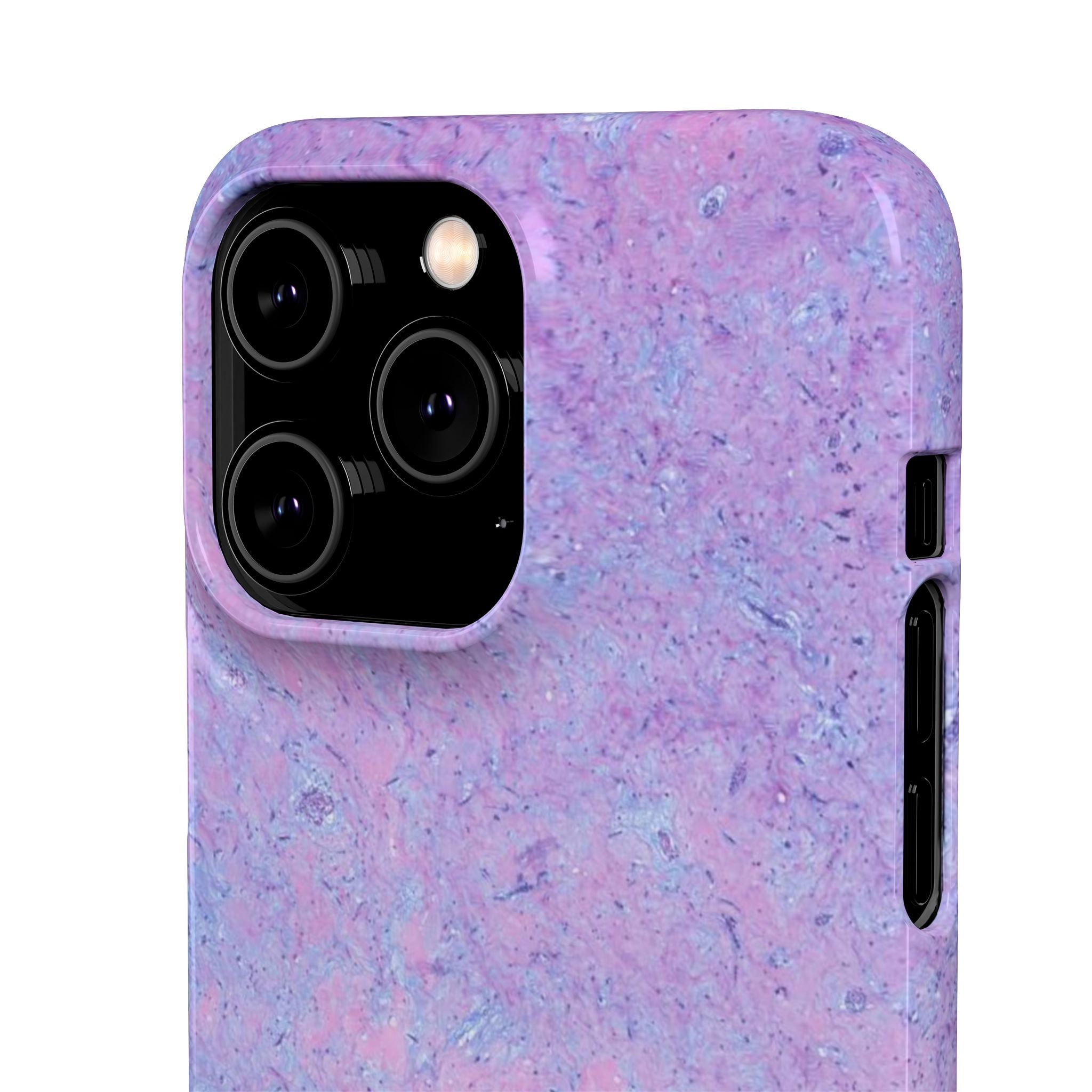 Slim Case Arterielles Myxom