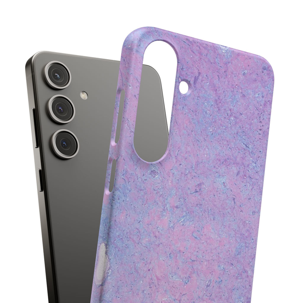 Slim Case Arterielles Myxom