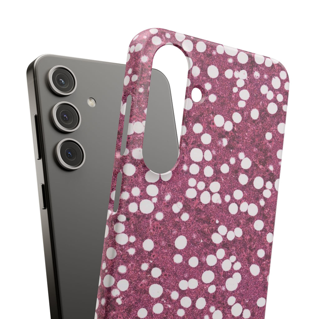 Slim Case Myelolipom