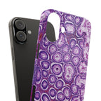 Slim Case Peutz-Jeghers Polyp