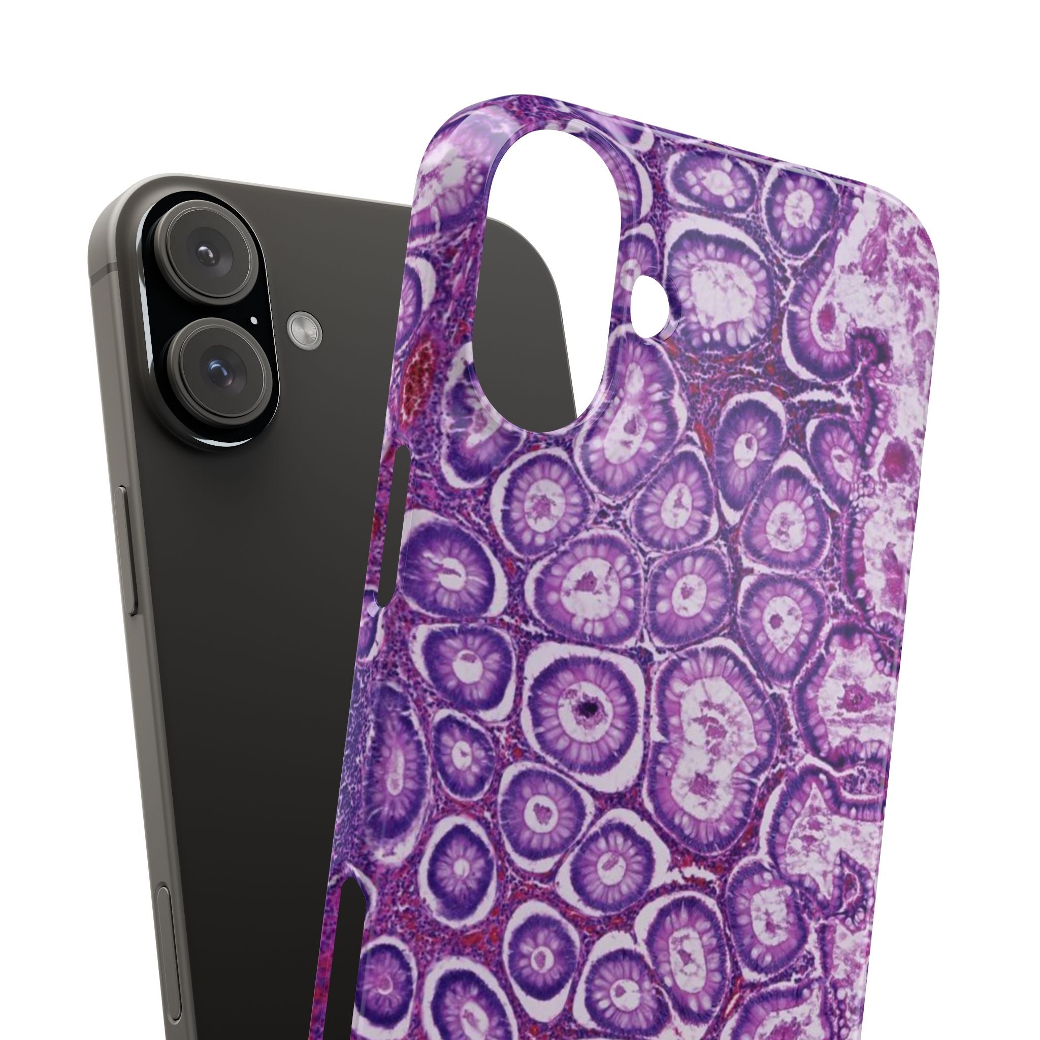 Slim Case Peutz-Jeghers Polyp