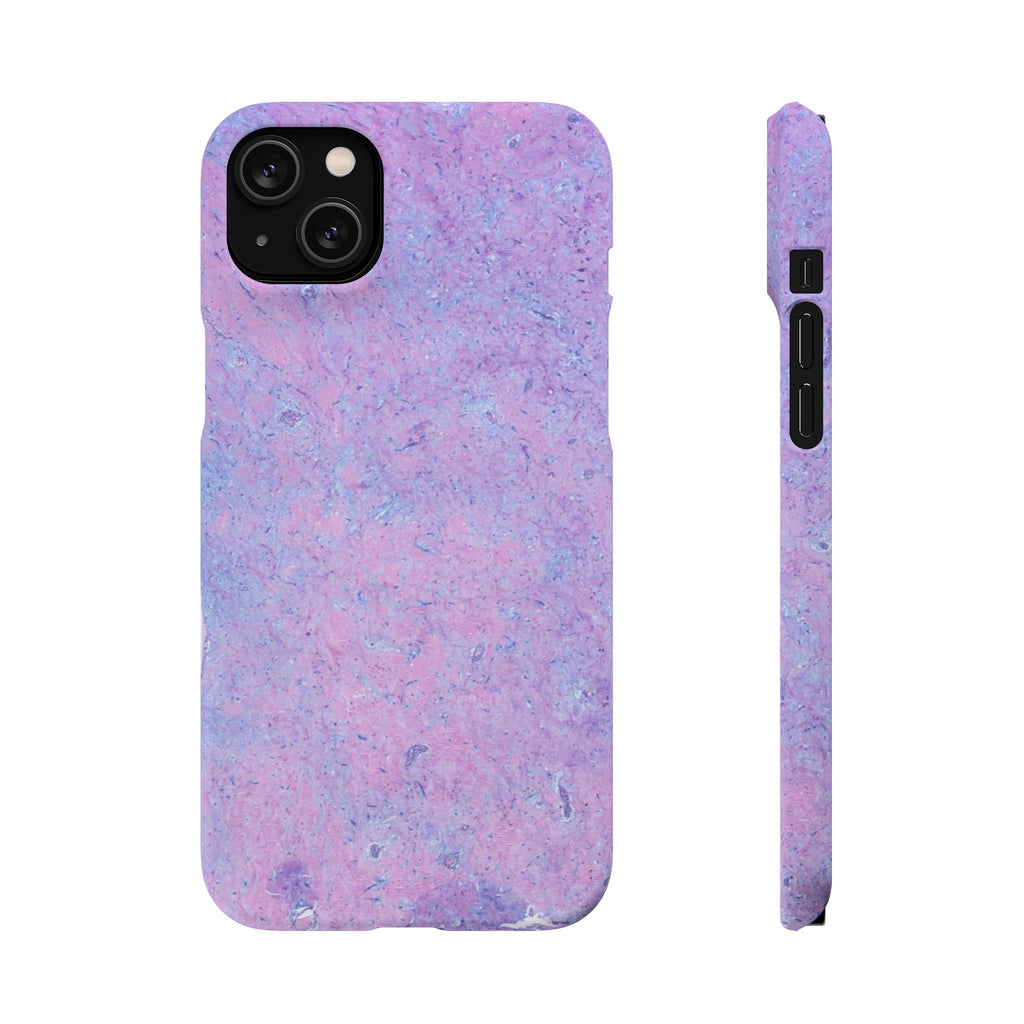Slim Case Arterielles Myxom