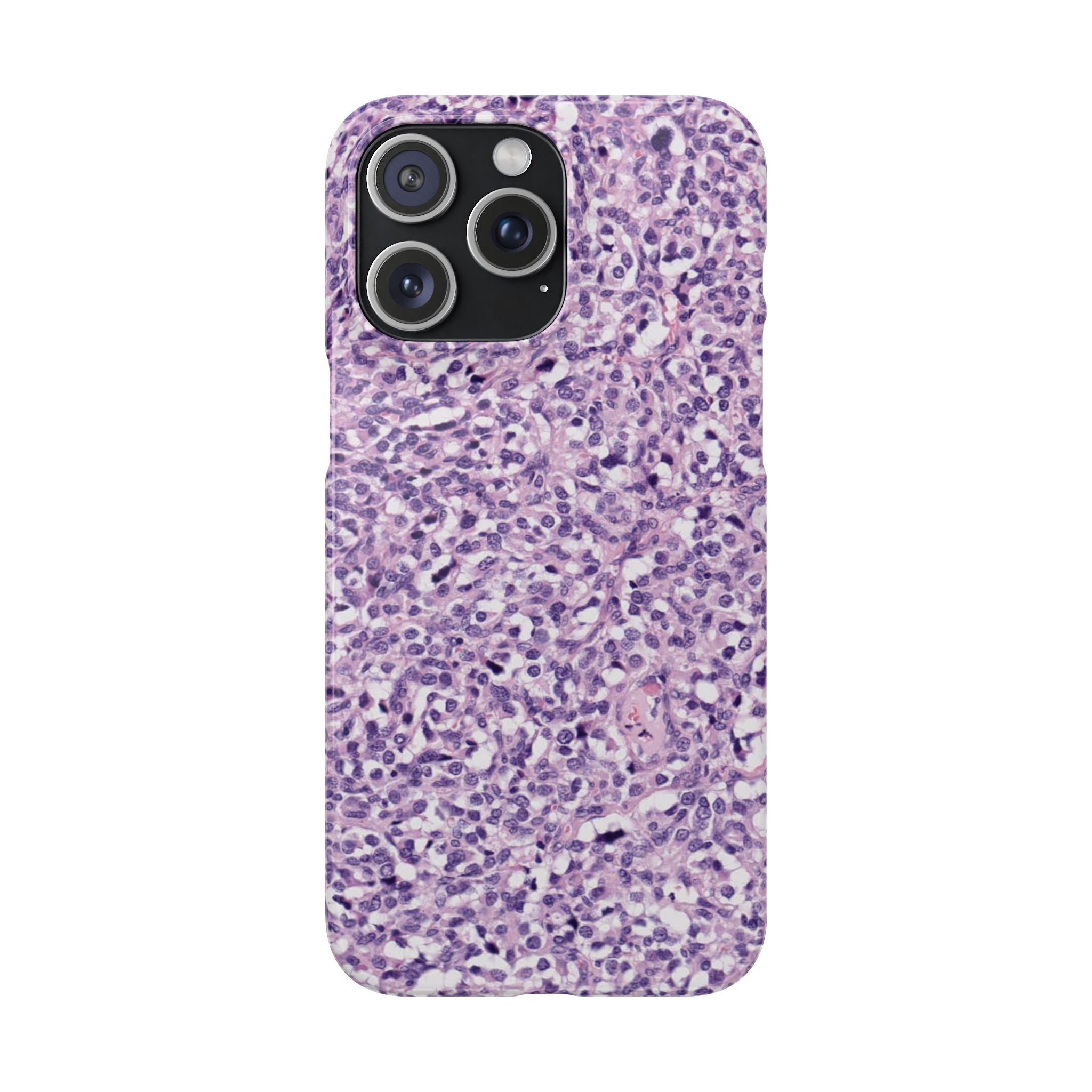 Slim Case Paraganglion