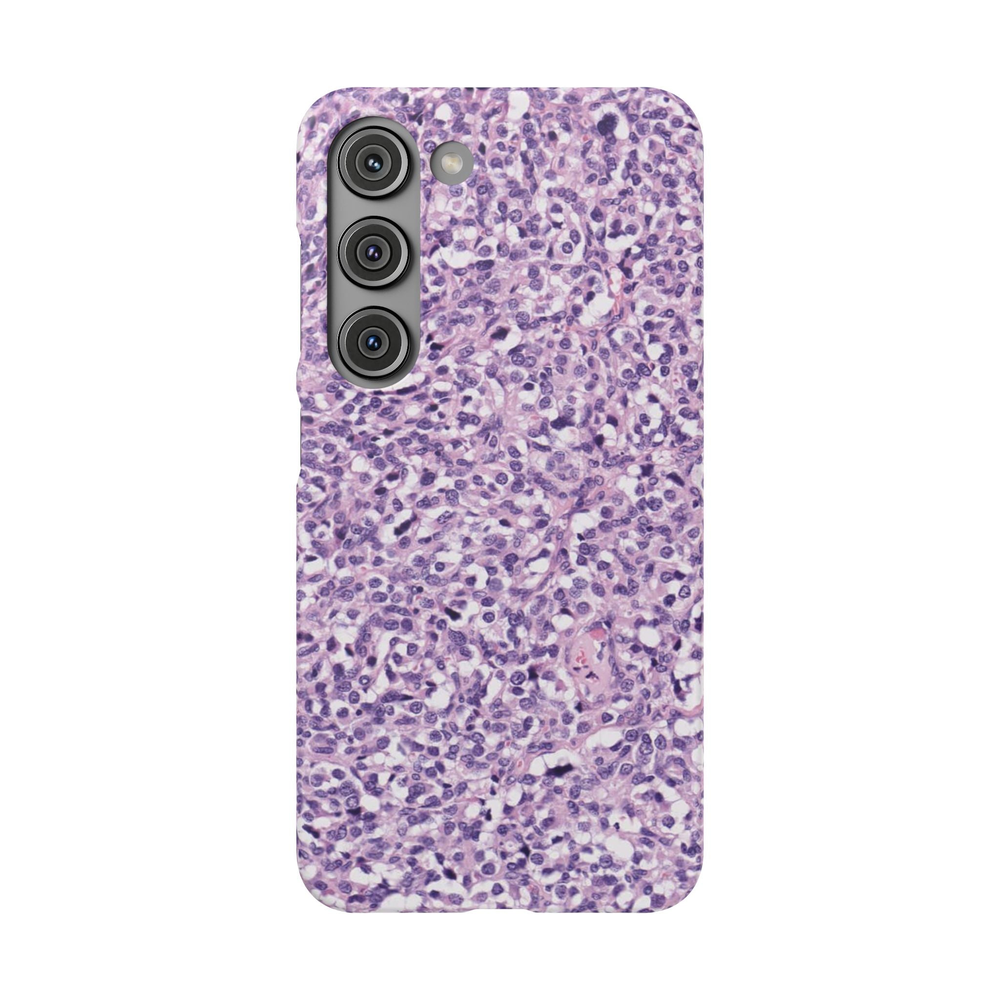 Slim Case Paraganglion
