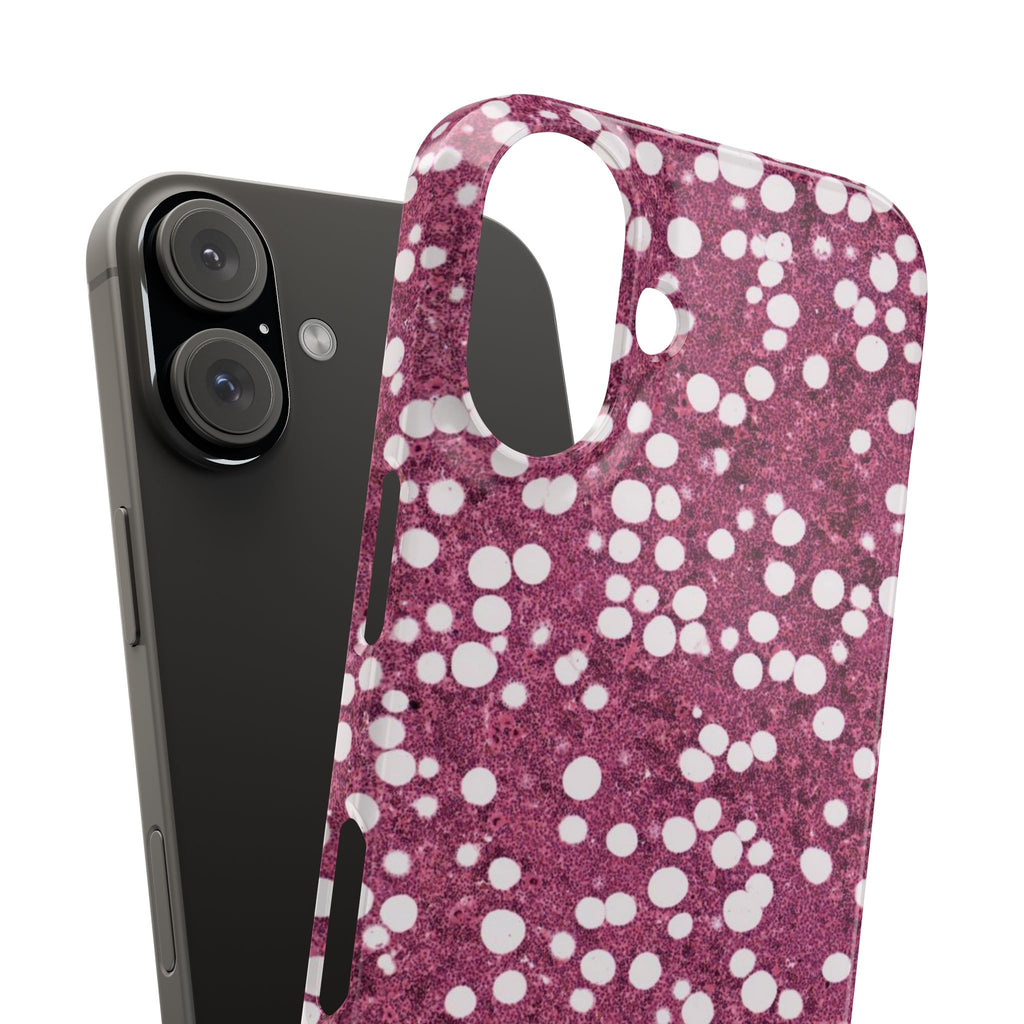Slim Case Myelolipom