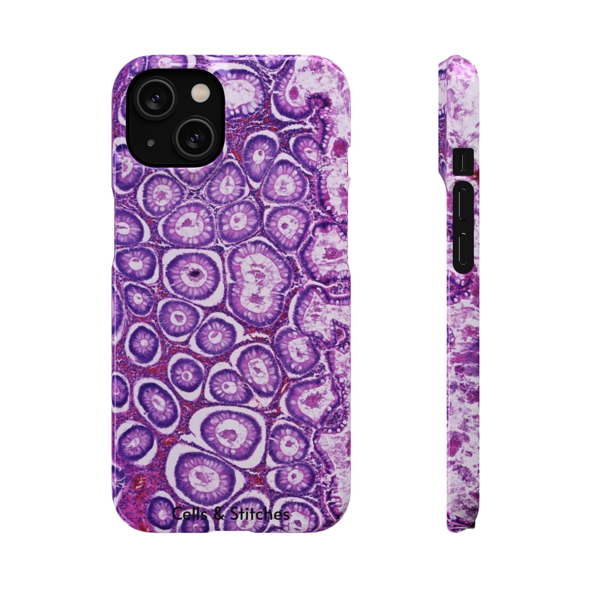Slim Case Peutz-Jeghers Polyp