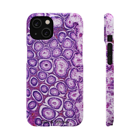 Slim Case Peutz-Jeghers Polyp