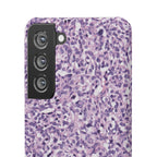 Slim Case Paraganglion