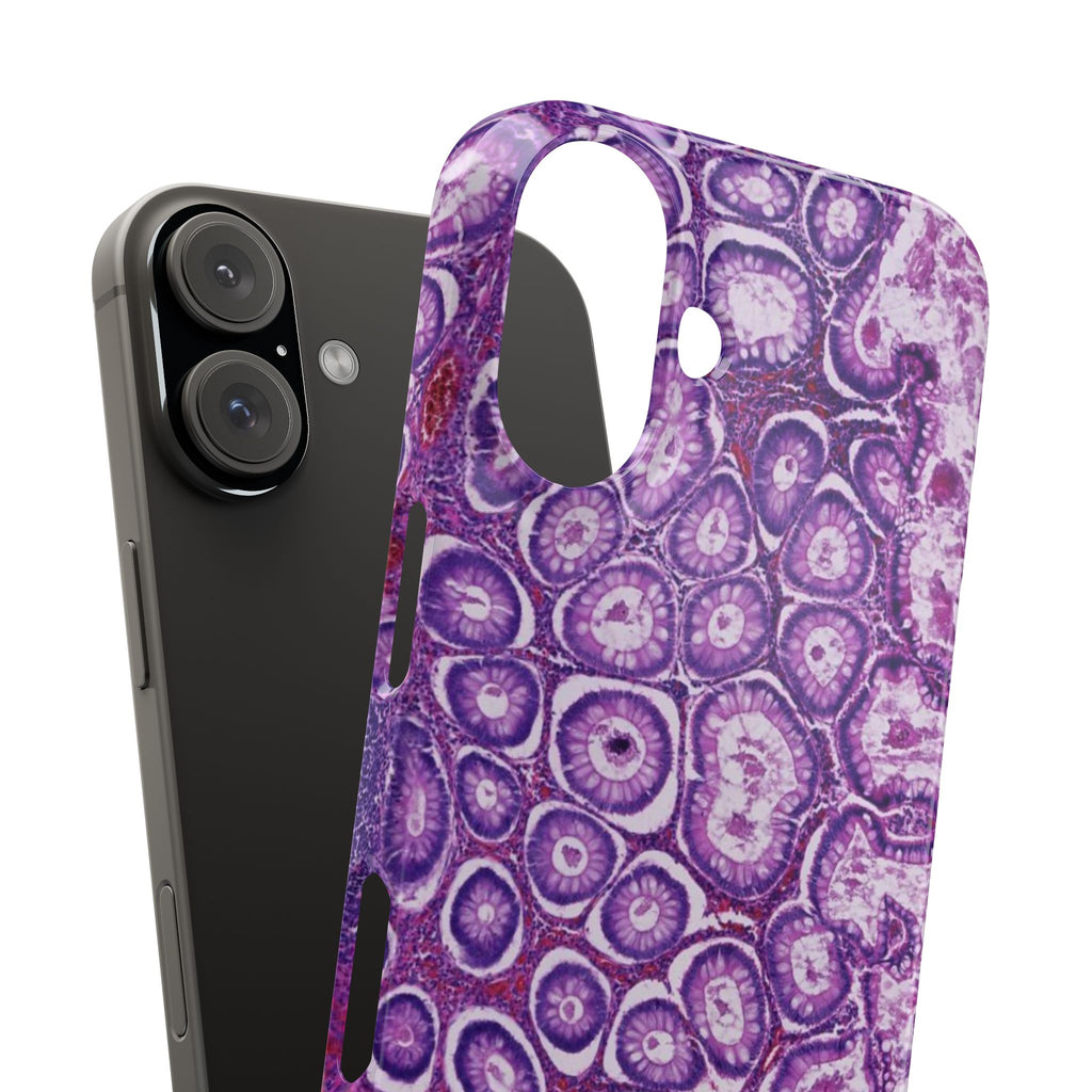 Slim Case Peutz-Jeghers Polyp