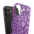 Slim Case Peutz-Jeghers Polyp