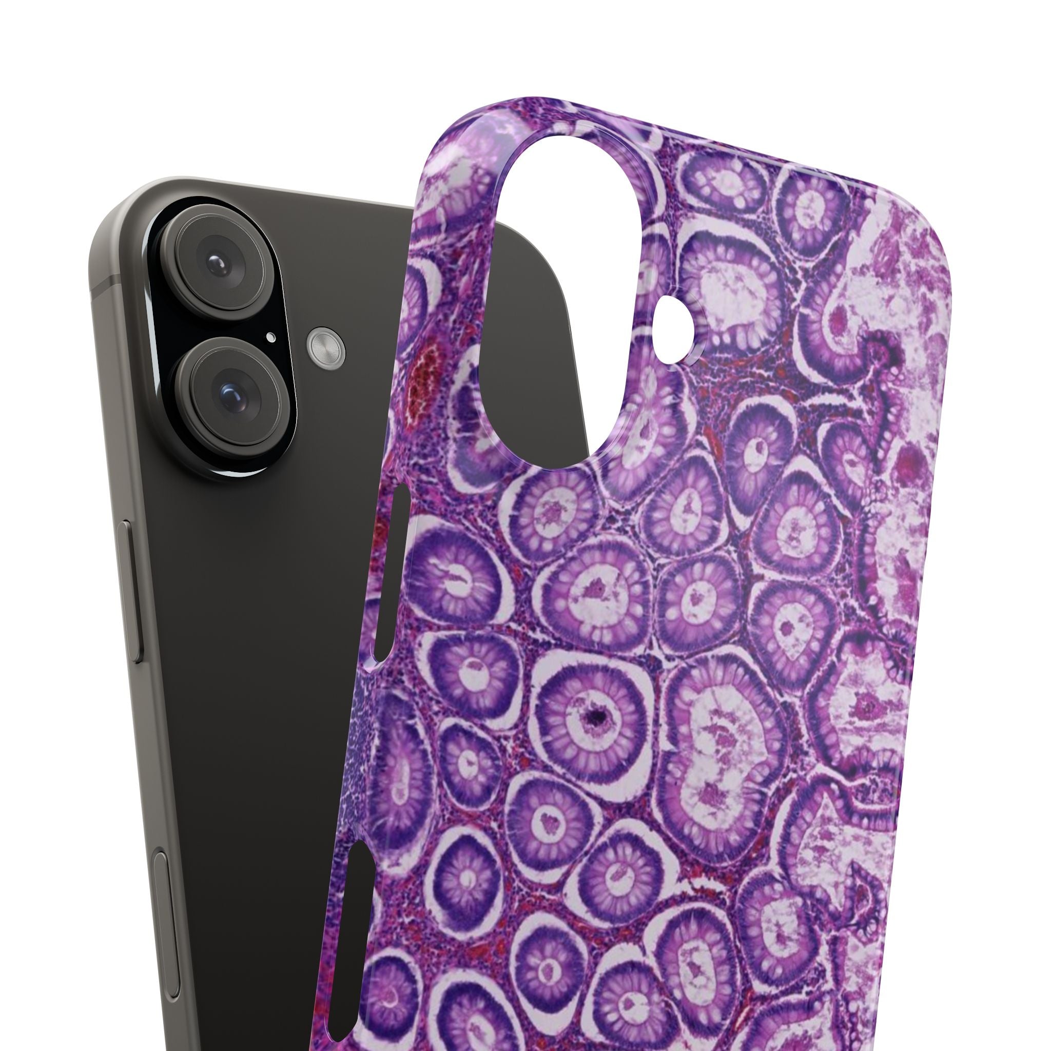 Slim Case Peutz-Jeghers Polyp