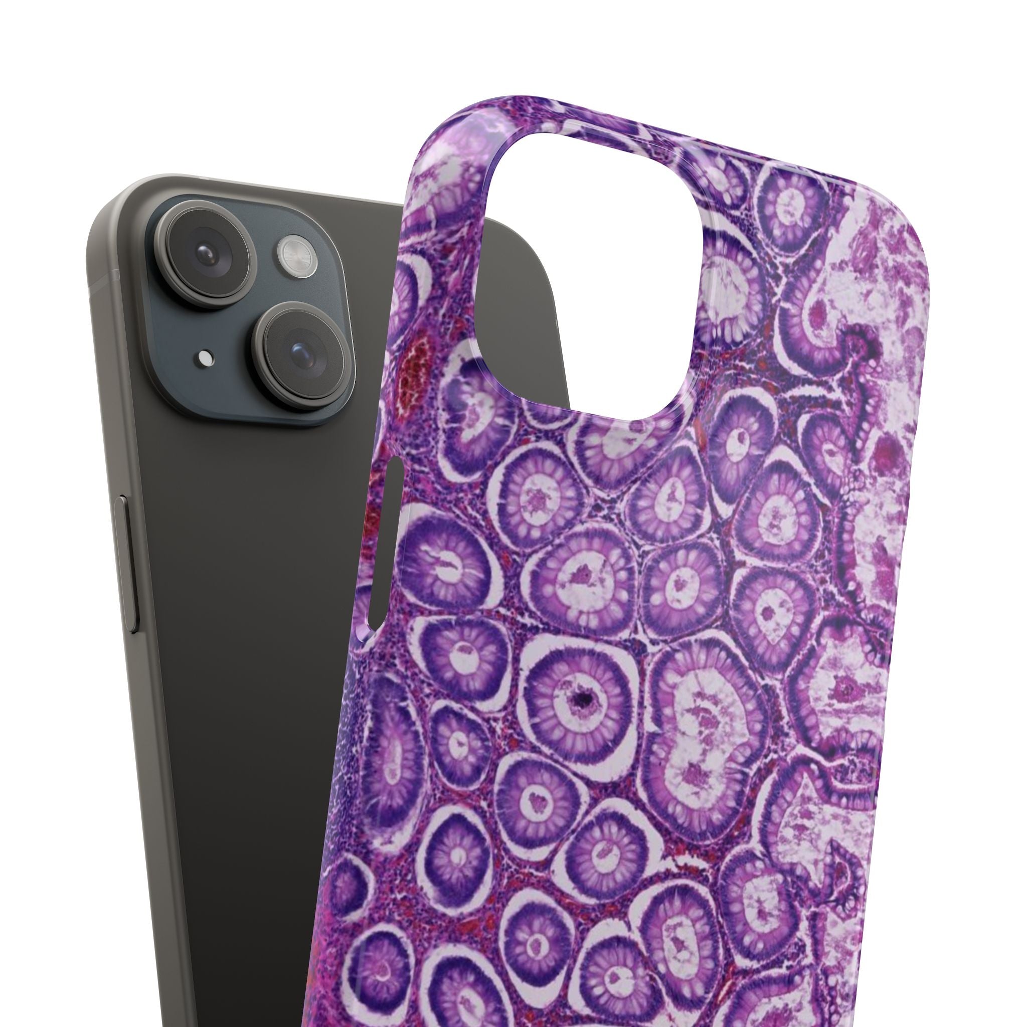 Slim Case Peutz-Jeghers Polyp