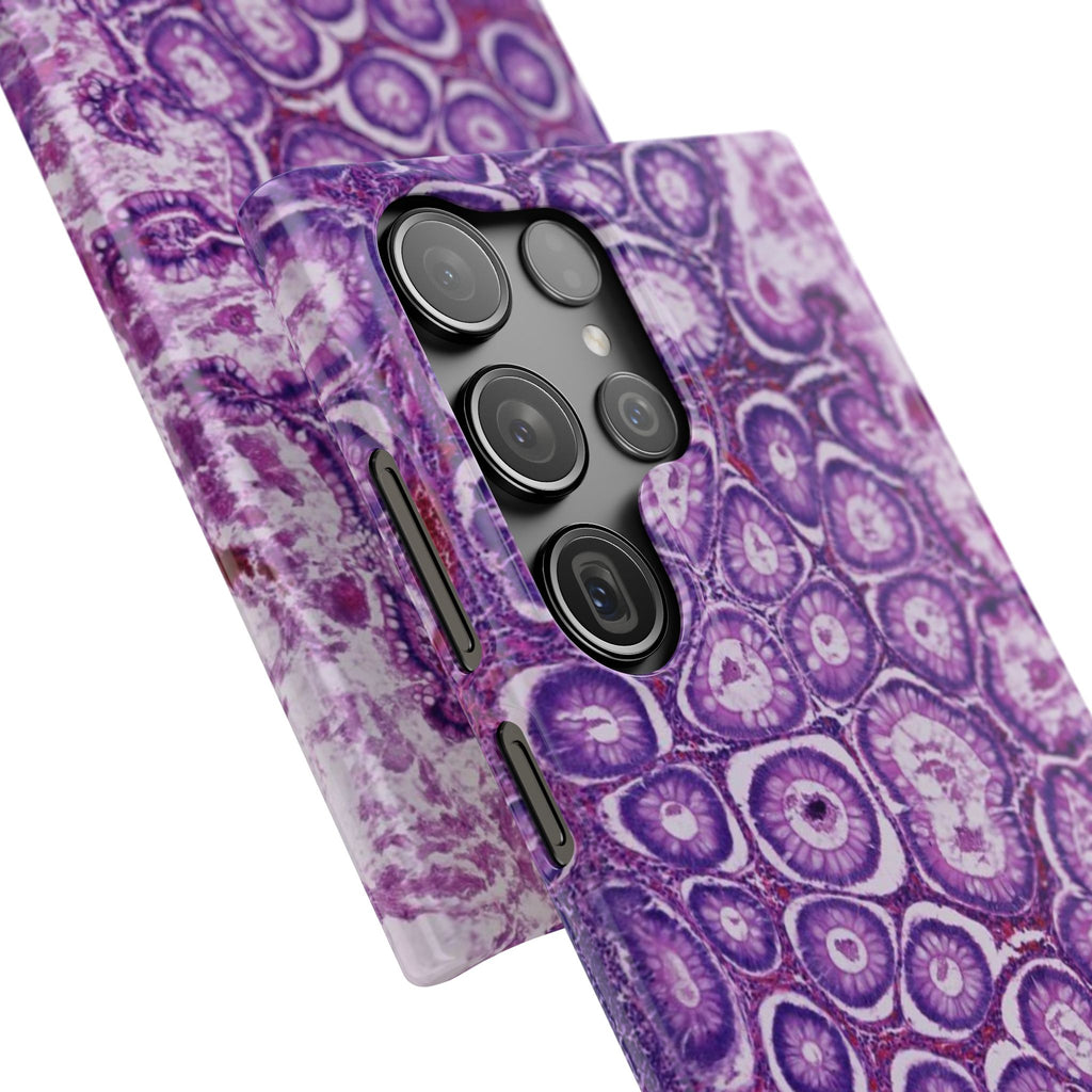 Slim Case Peutz-Jeghers Polyp