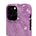 Slim Case Endometrium