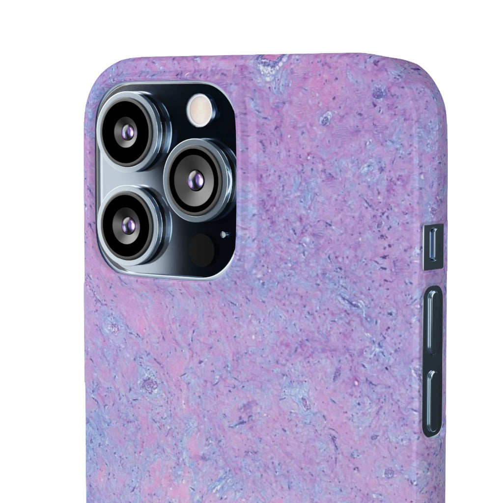 Slim Case Arterielles Myxom