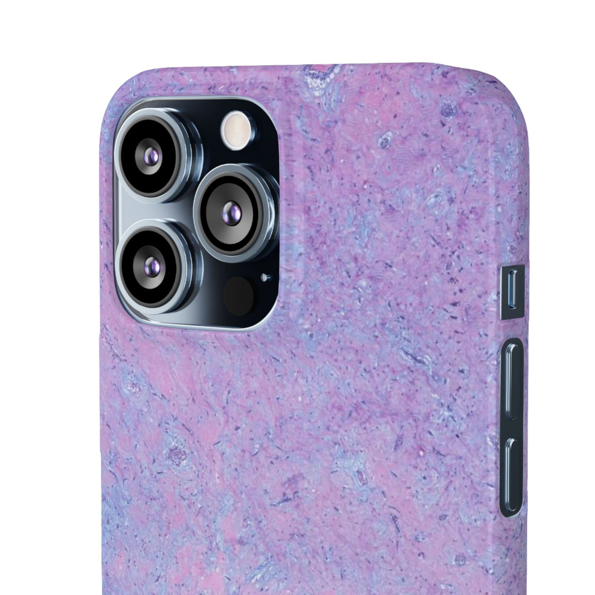 Slim Case Arterielles Myxom