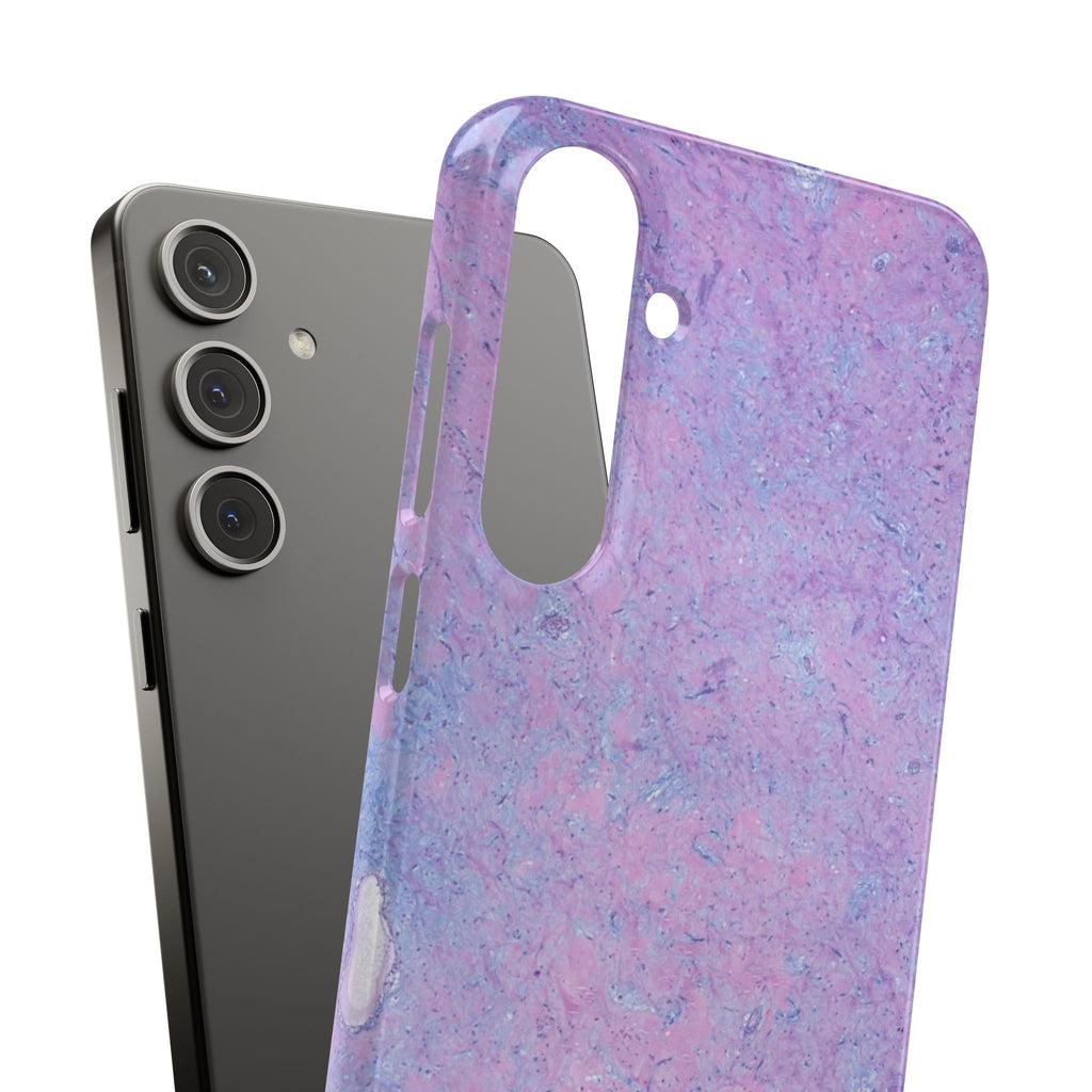 Slim Case Arterielles Myxom