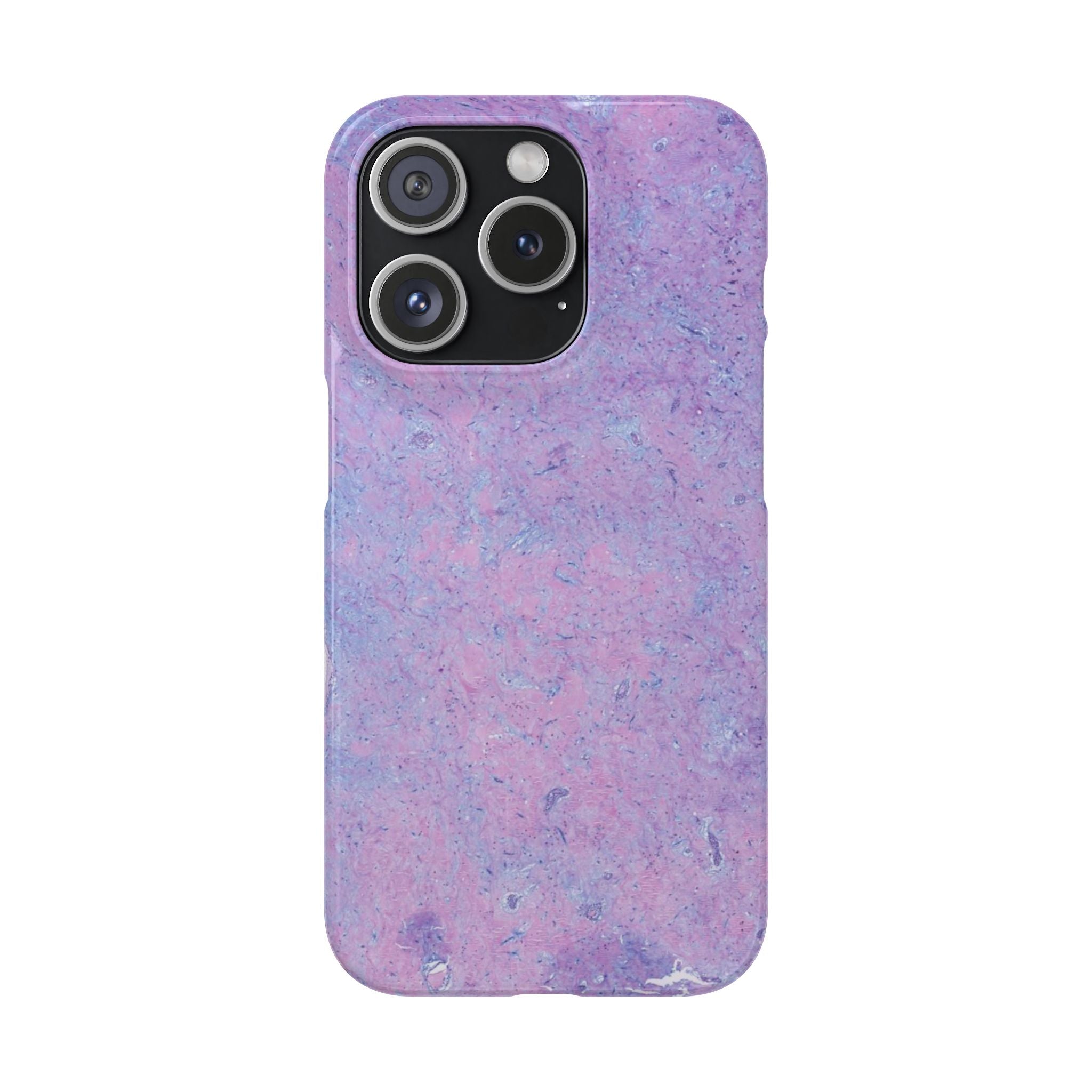 Slim Case Arterielles Myxom
