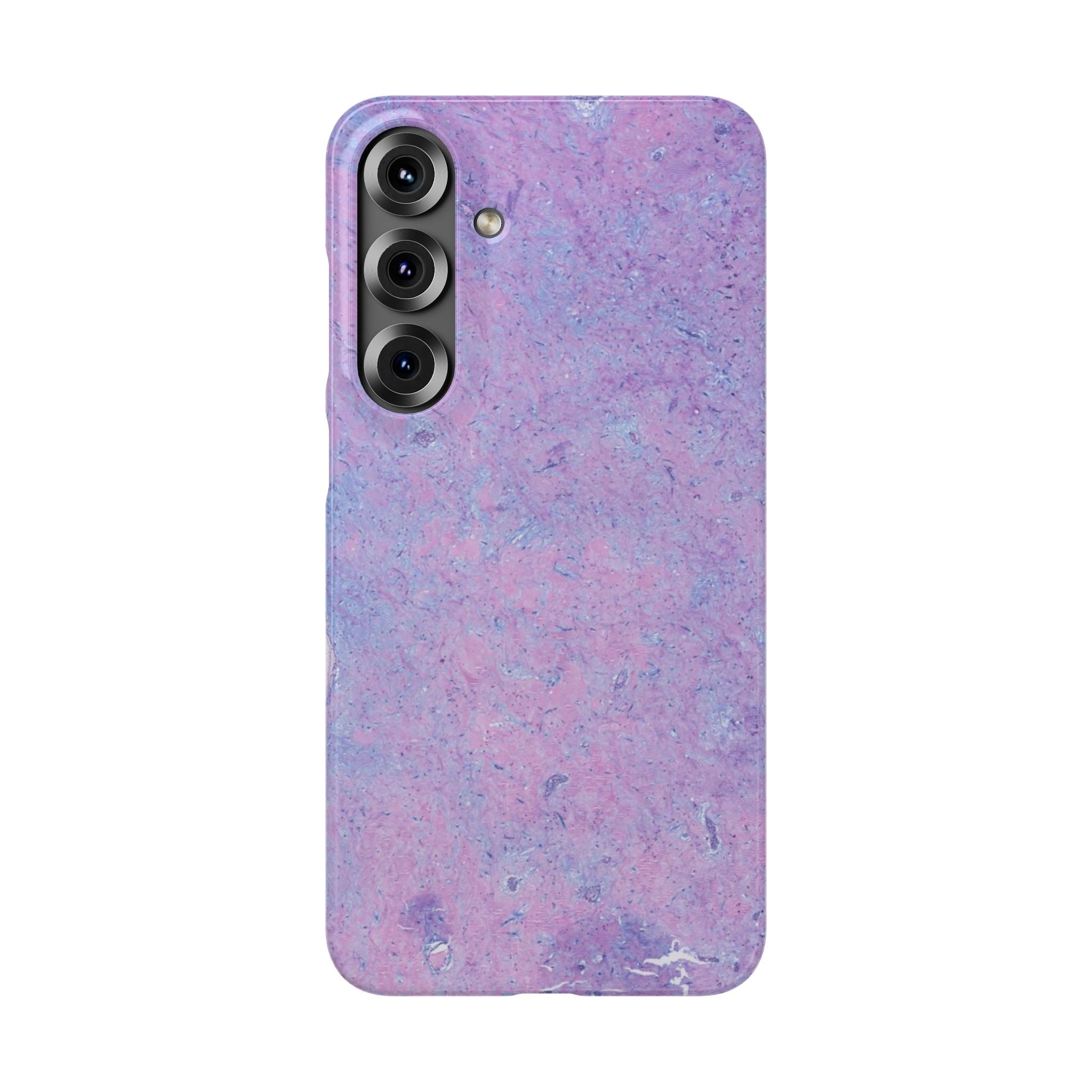 Slim Case Arterielles Myxom