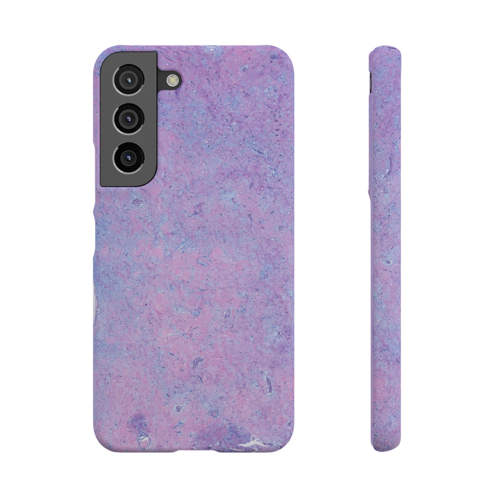 Slim Case Arterielles Myxom