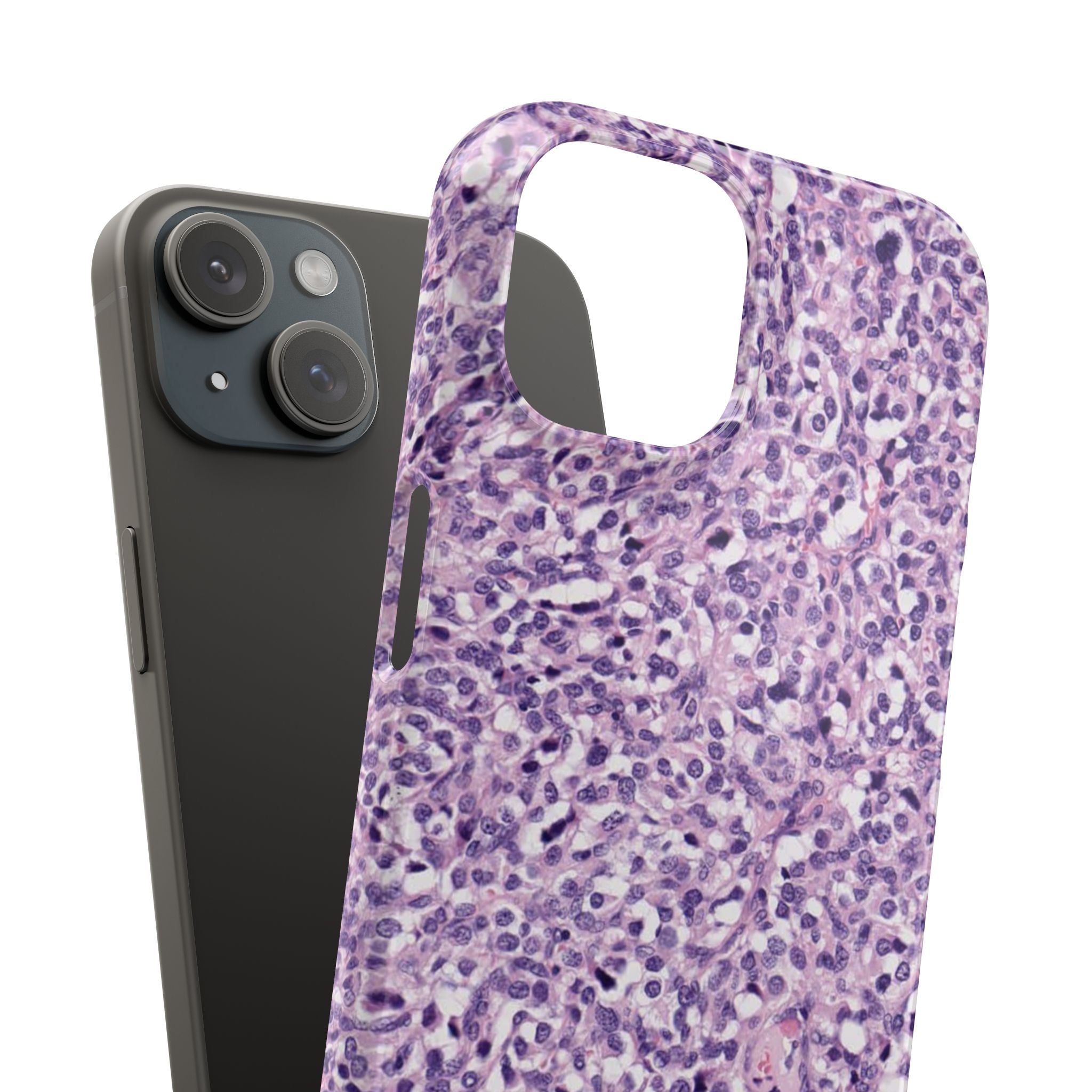 Slim Case Paraganglion