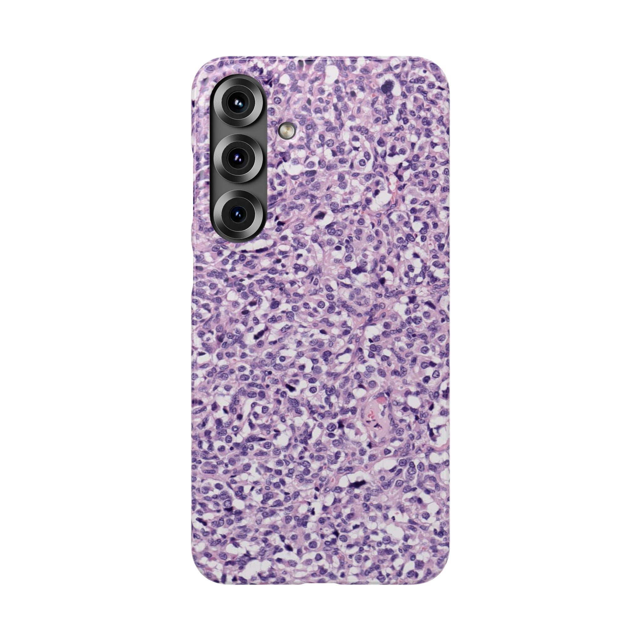 Slim Case Paraganglion
