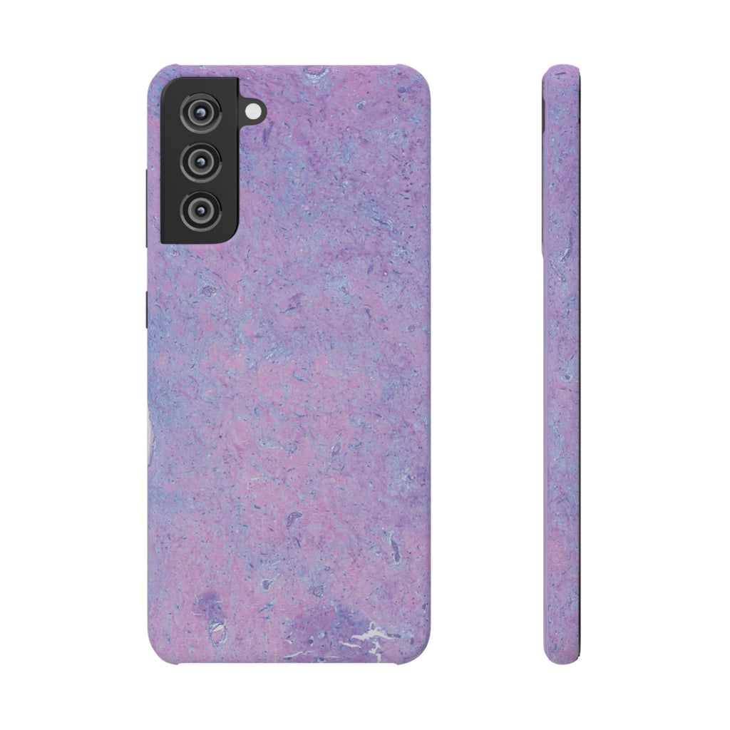 Slim Case Arterielles Myxom