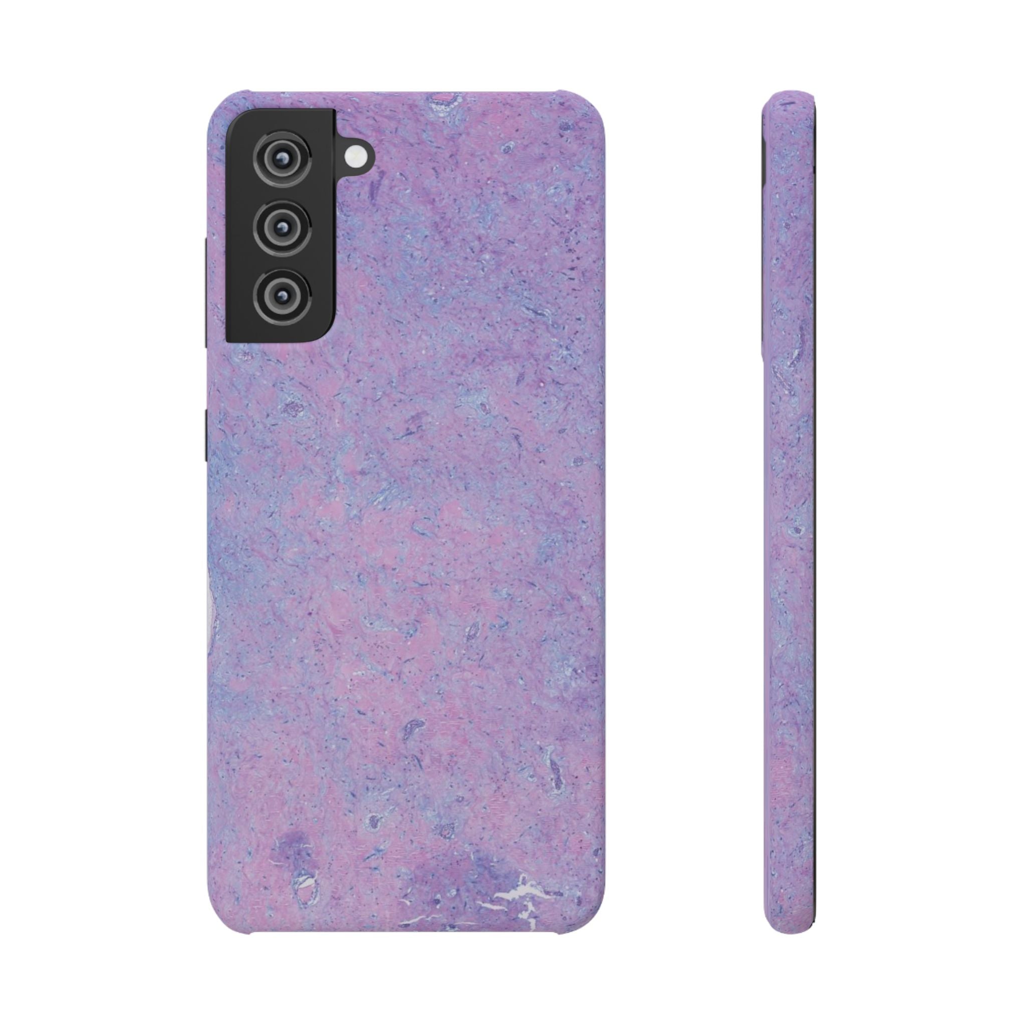 Slim Case Arterielles Myxom