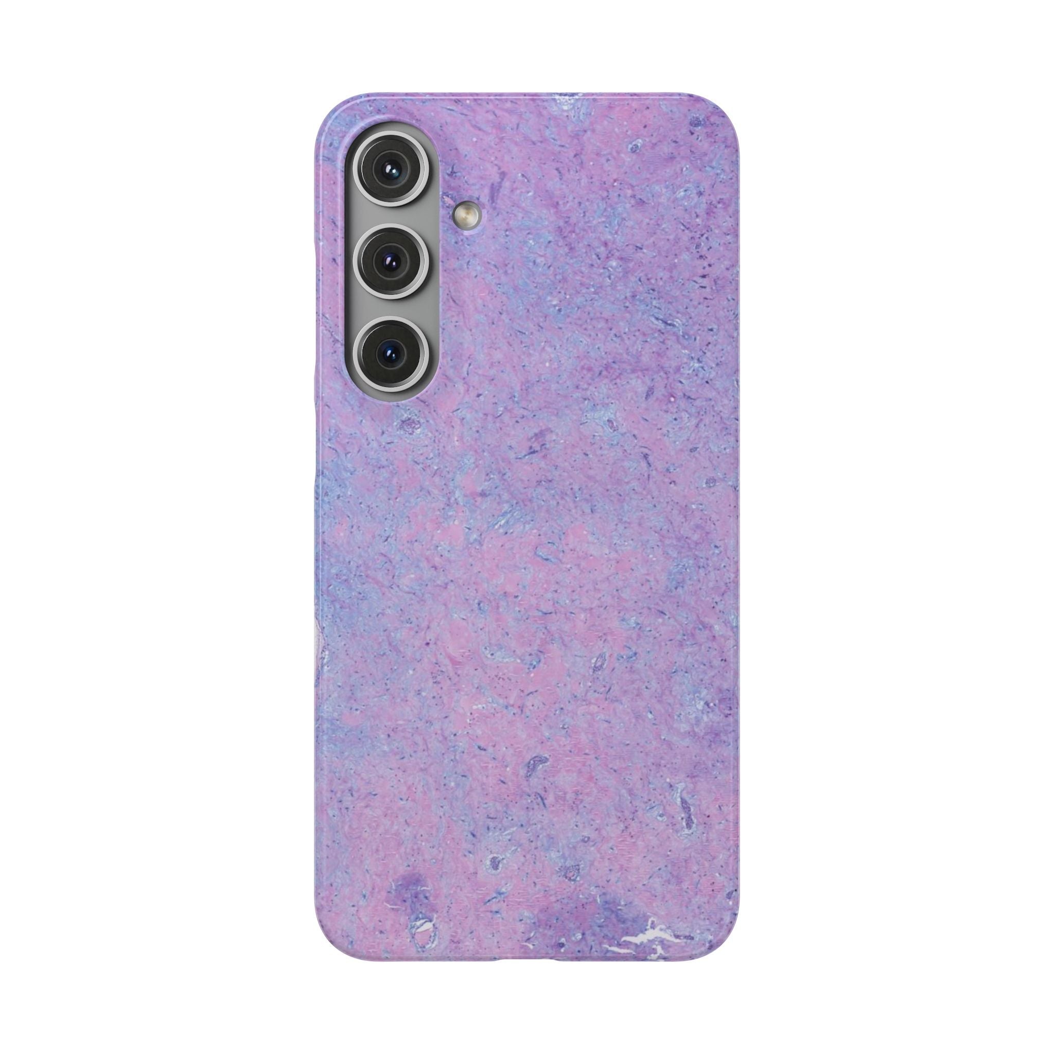 Slim Case Arterielles Myxom