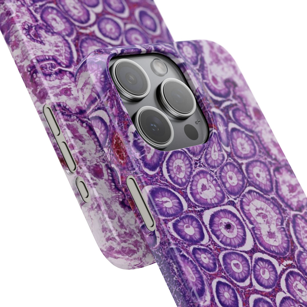 Slim Case Peutz-Jeghers Polyp