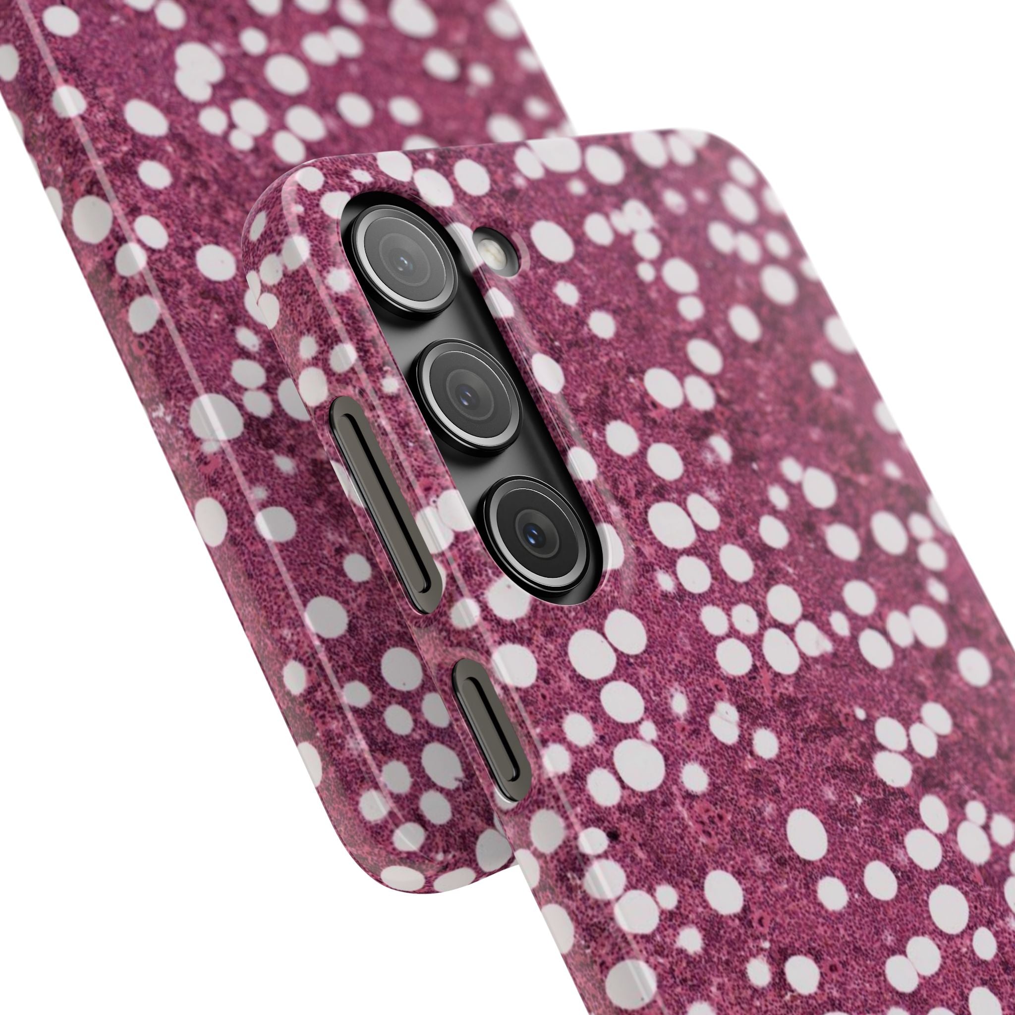Slim Case Myelolipom