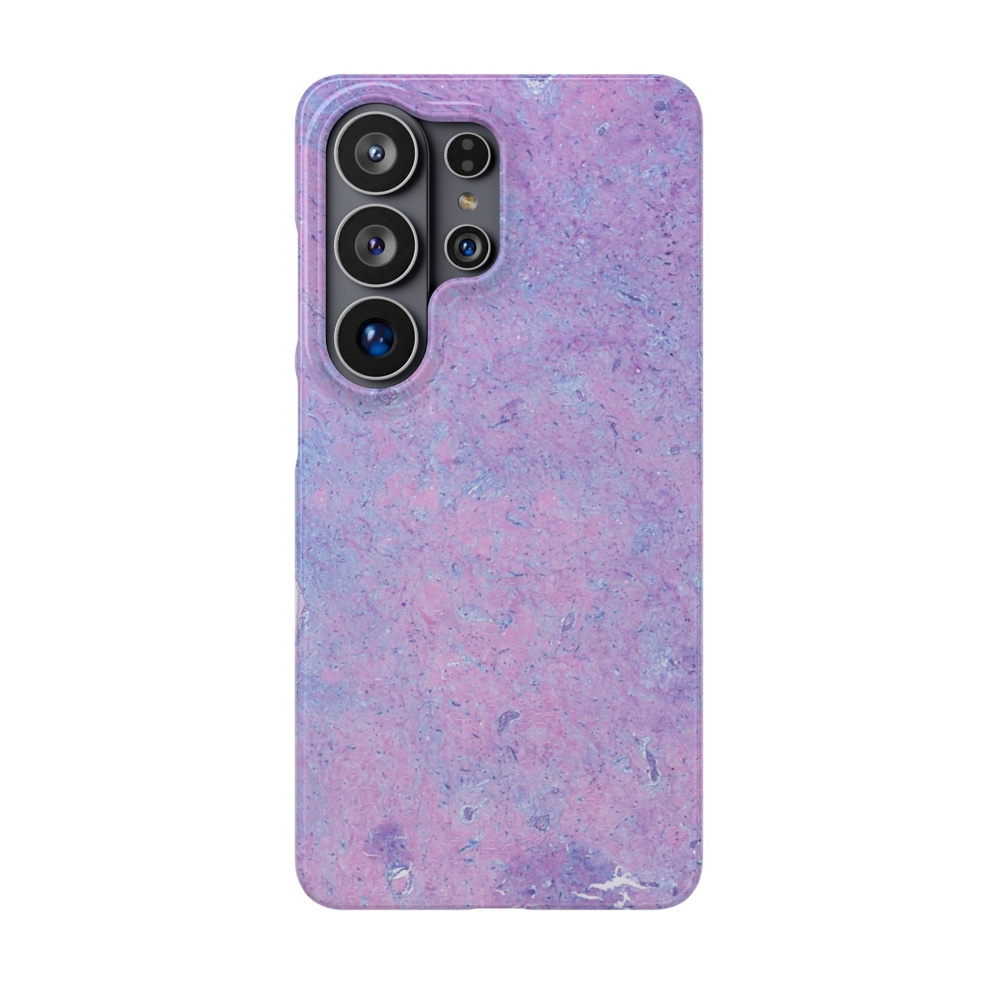 Slim Case Arterielles Myxom