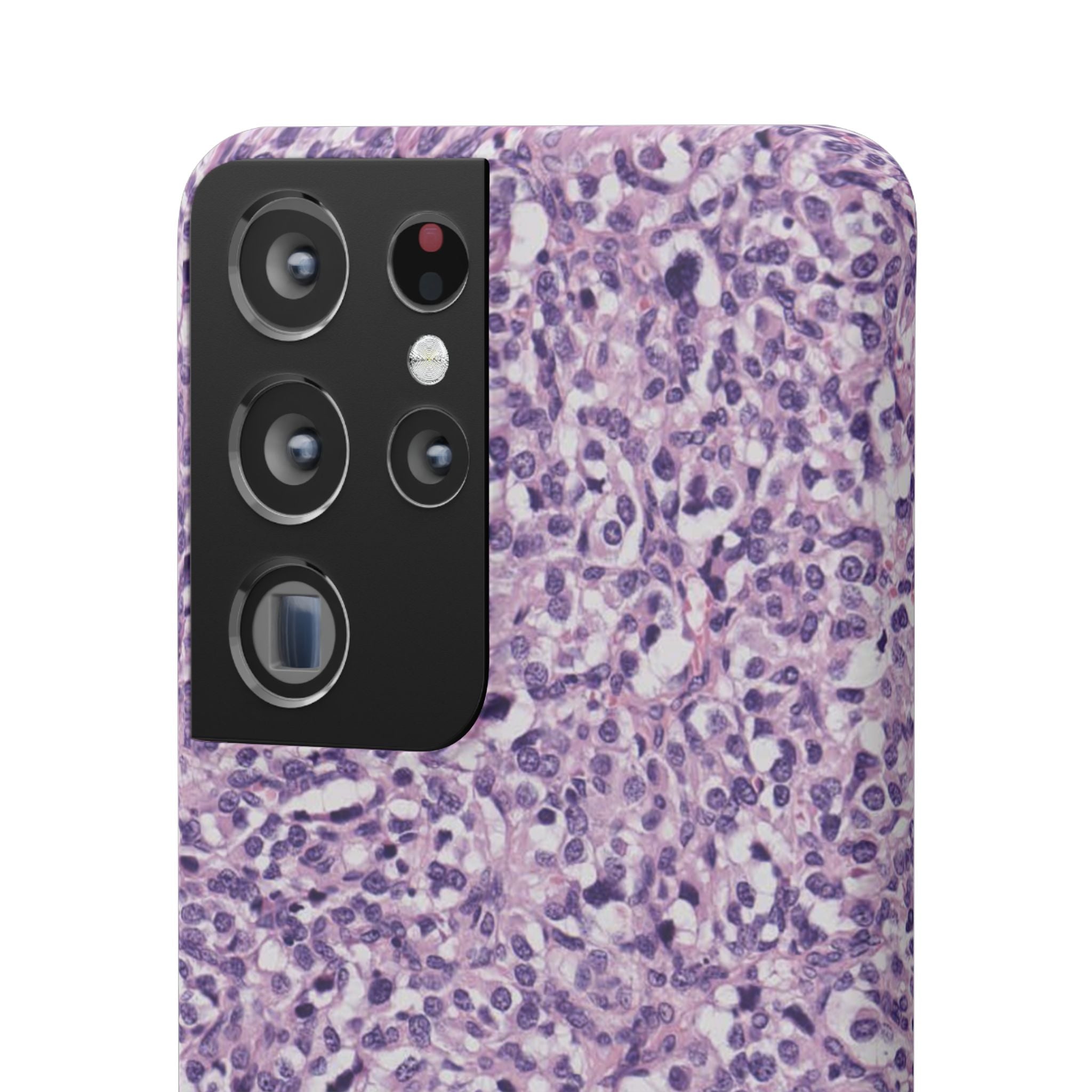 Slim Case Paraganglion