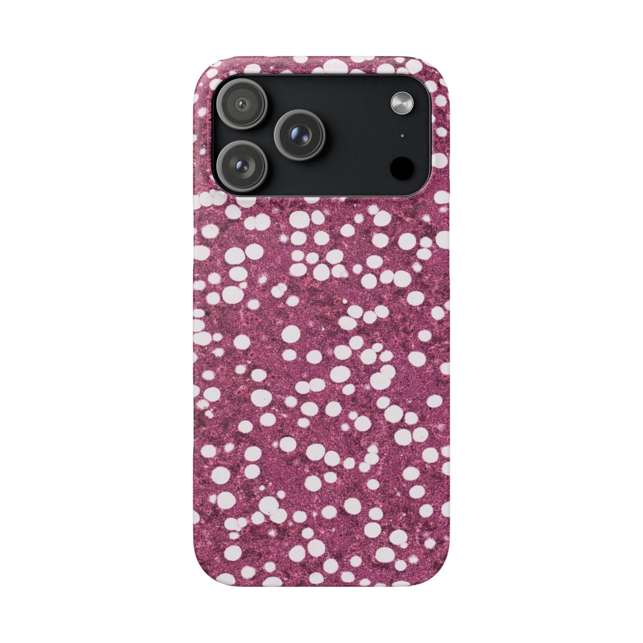 Slim Case Myelolipom