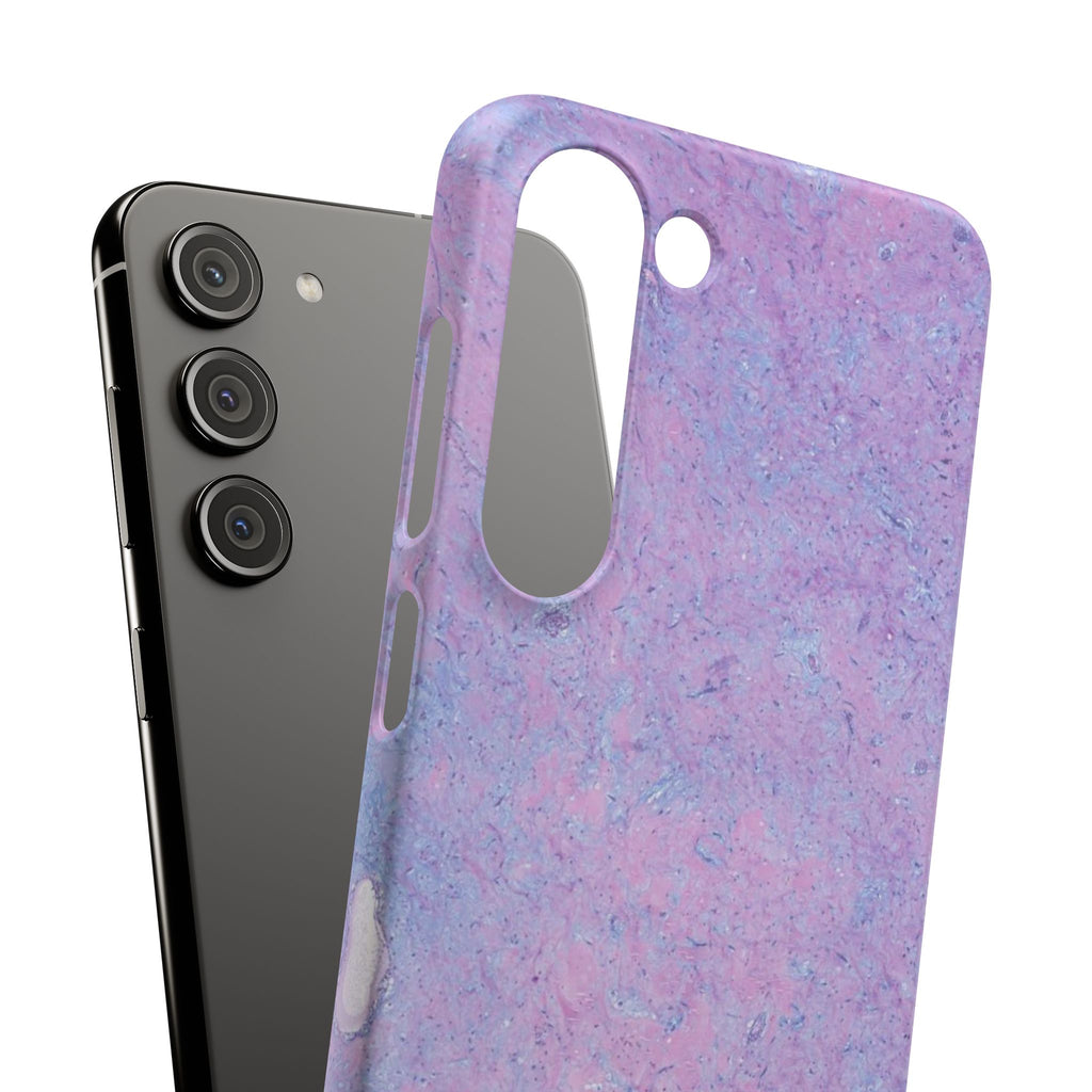 Slim Case Arterielles Myxom