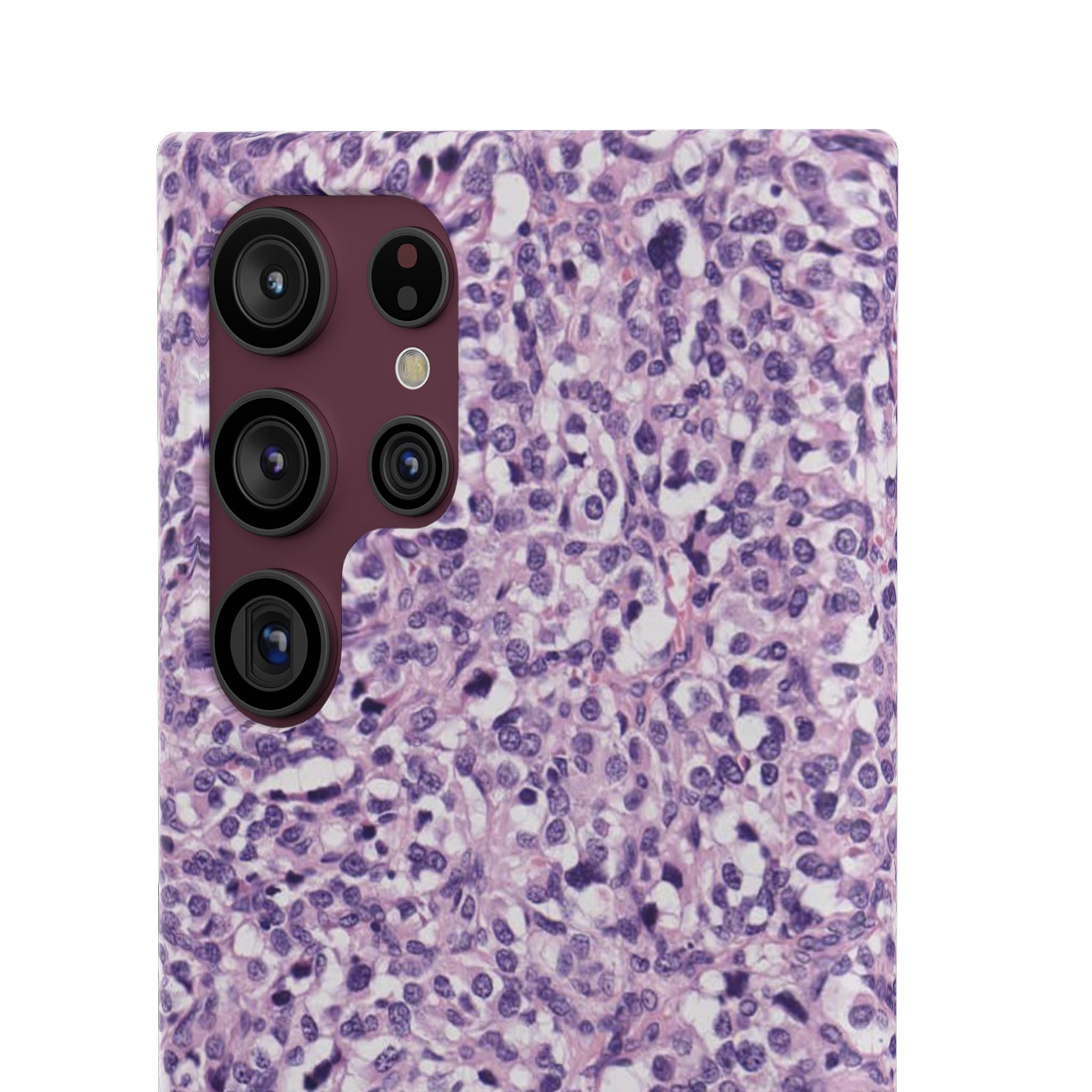 Slim Case Paraganglion