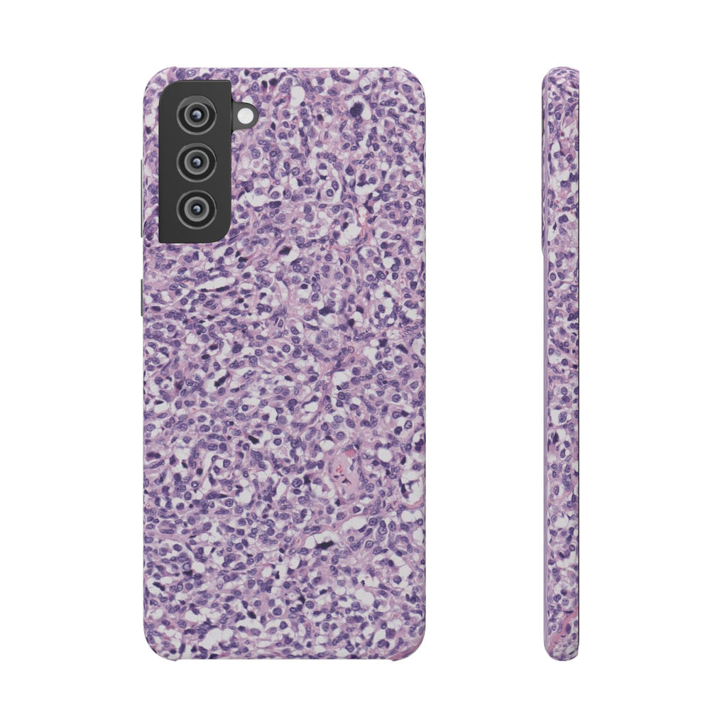 Slim Case Paraganglion