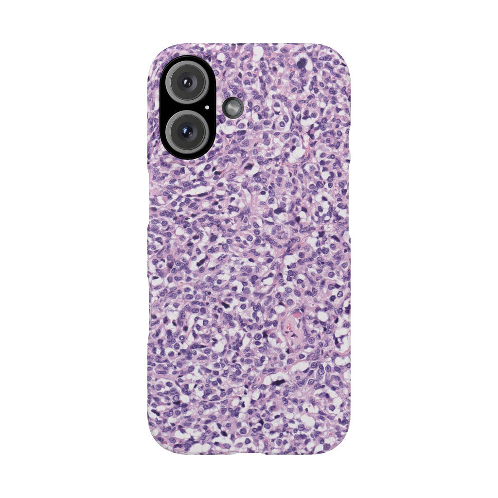 Slim Case Paraganglion