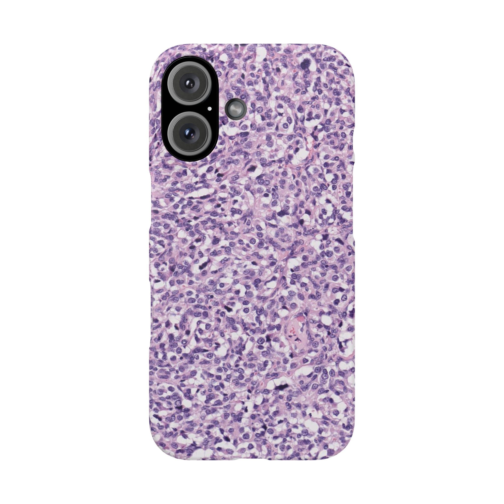 Slim Case Paraganglion