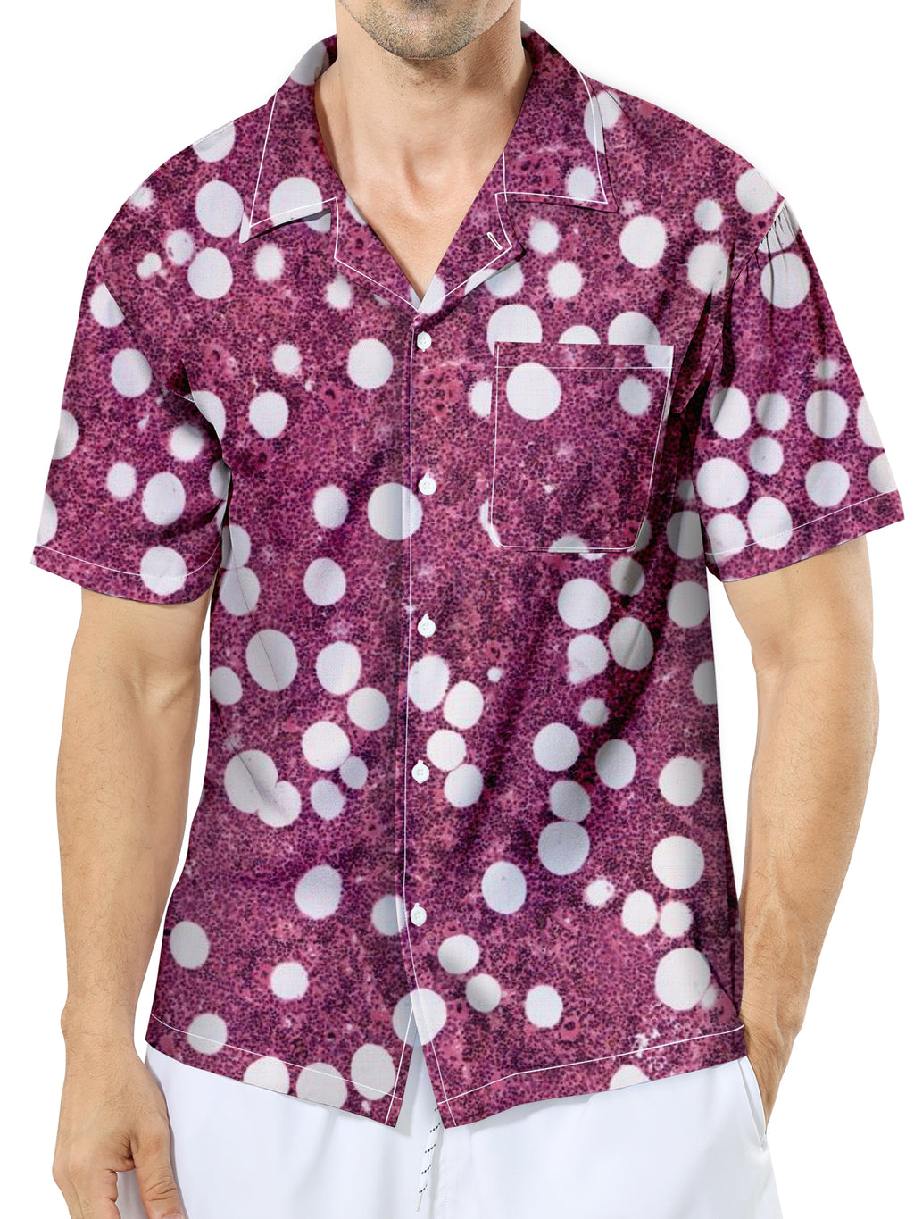 Adrenales Myelolipom Hemd